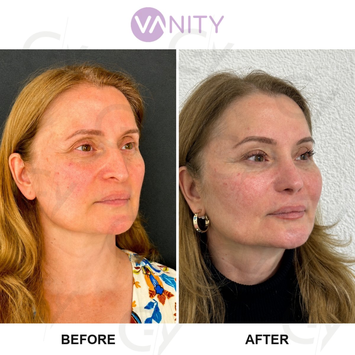 Resultados de lifting facial antes y después en Vanity Cosmetic Surgery Center, rejuvenecimiento
