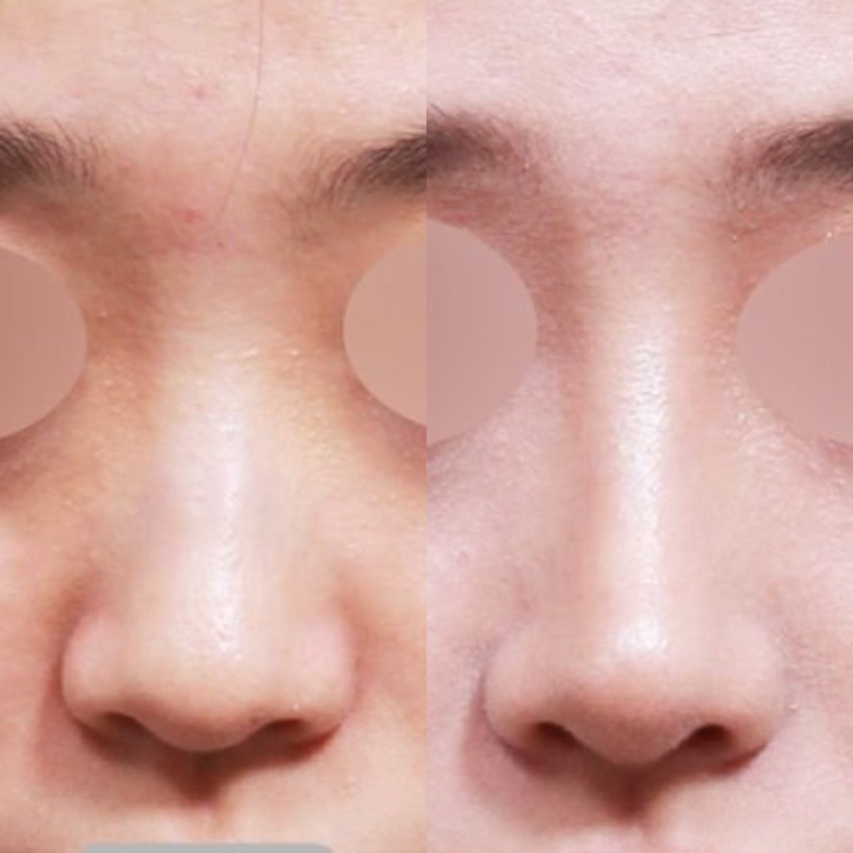 نتائج قبل وبعد تجميل طرف الأنف في VG Plastic Surgery، تحسين شكل الأنف