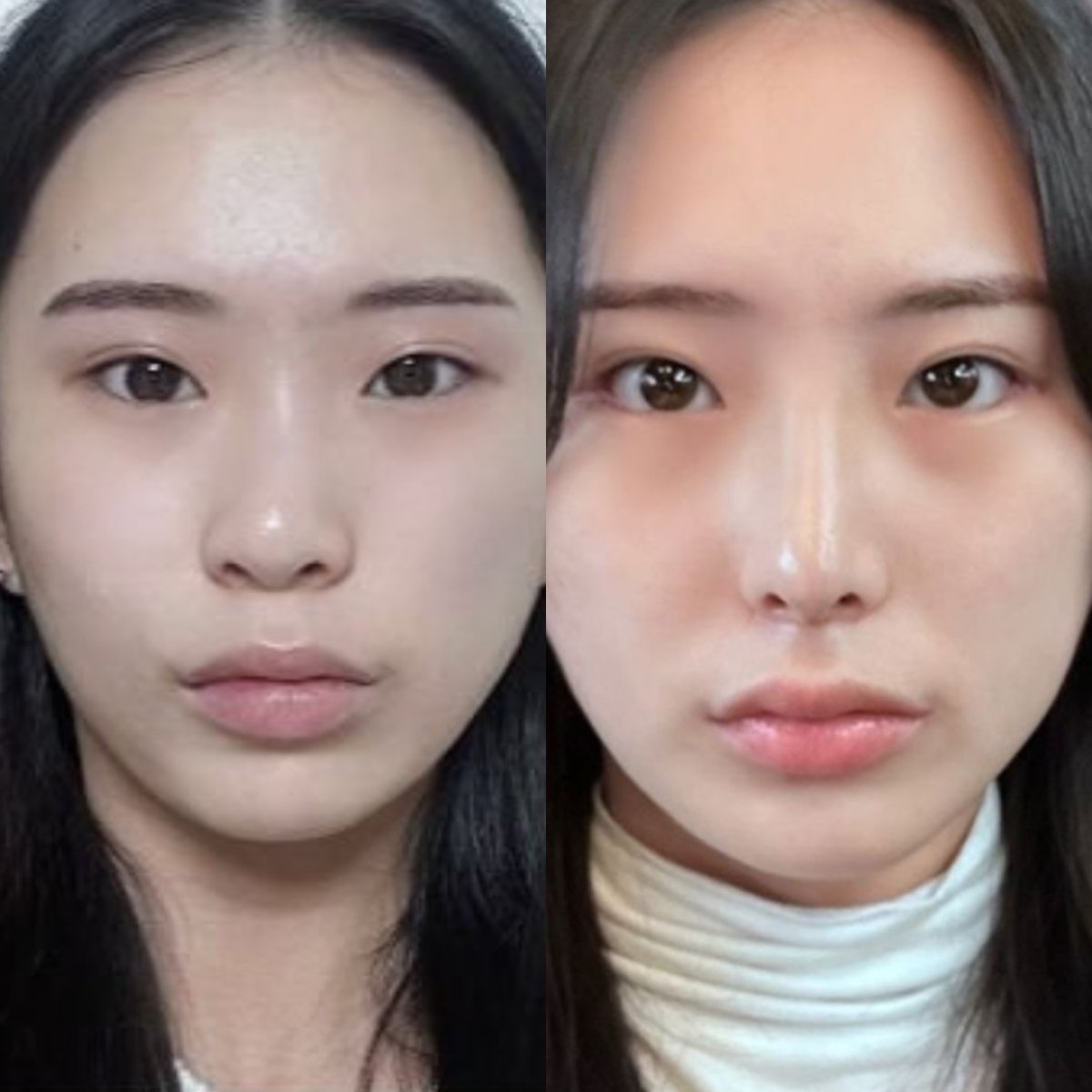 نتائج قبل وبعد تجميل طرف الأنف في VG Plastic Surgery، مظهر طرف أنف مصقول