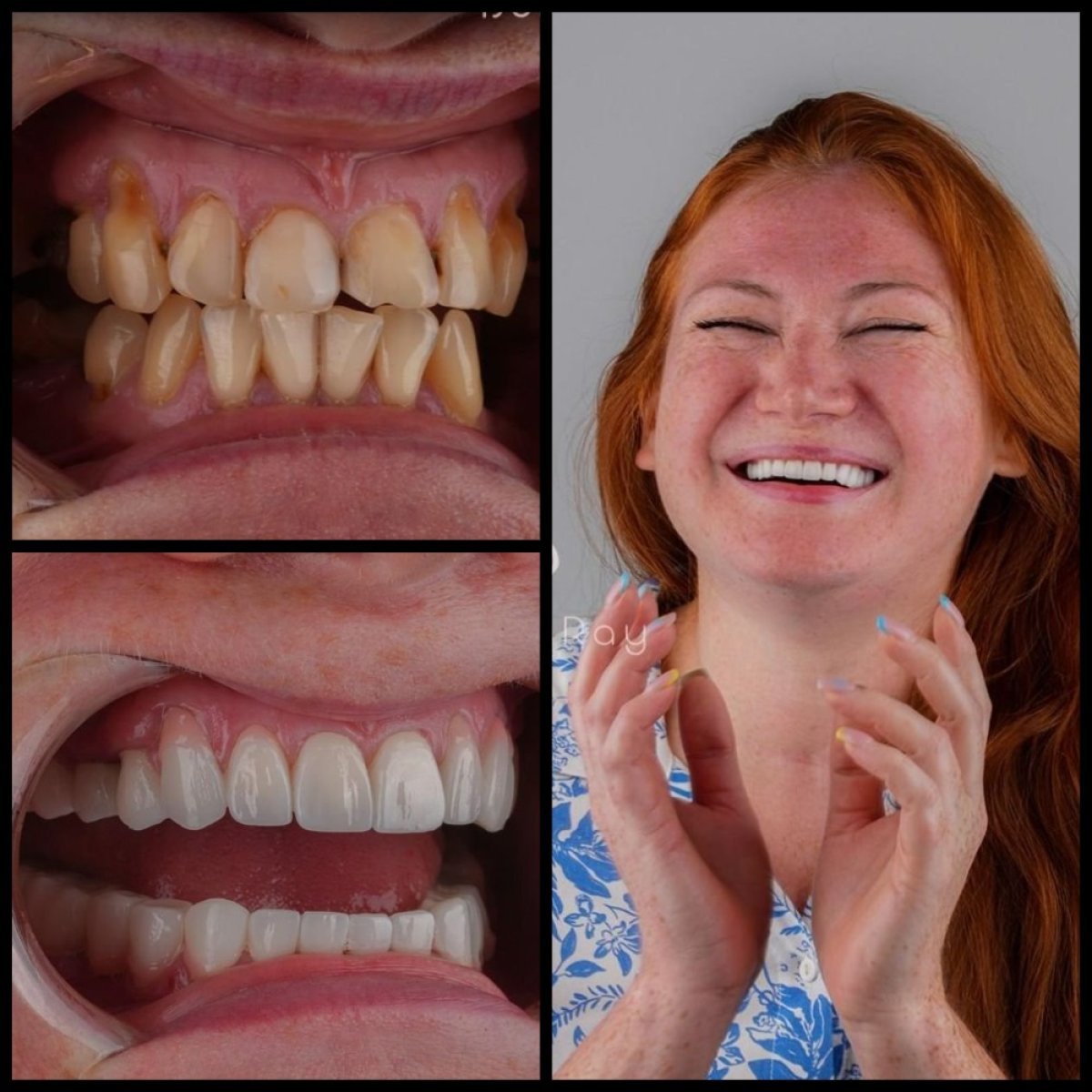 نتائج تبييض الأسنان قبل وبعد في عيادة Dentaray، تحول ملحوظ في الابتسامة