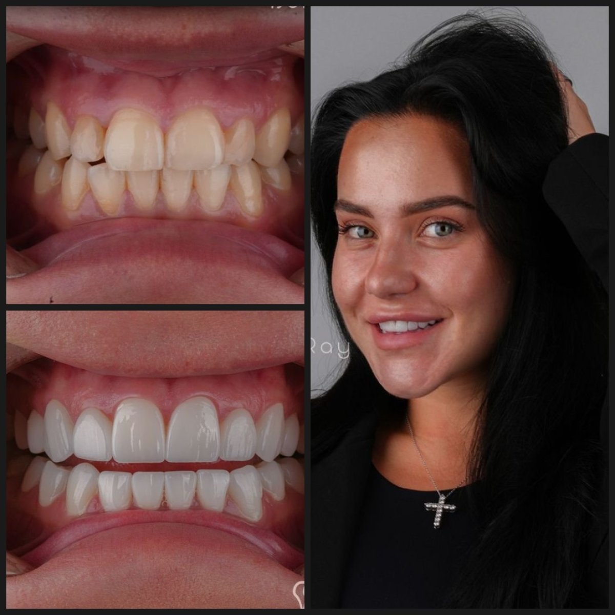 نتائج قبل وبعد قشور الأسنان في عيادة Dentaray، ابتسامة طبيعية وجذابة