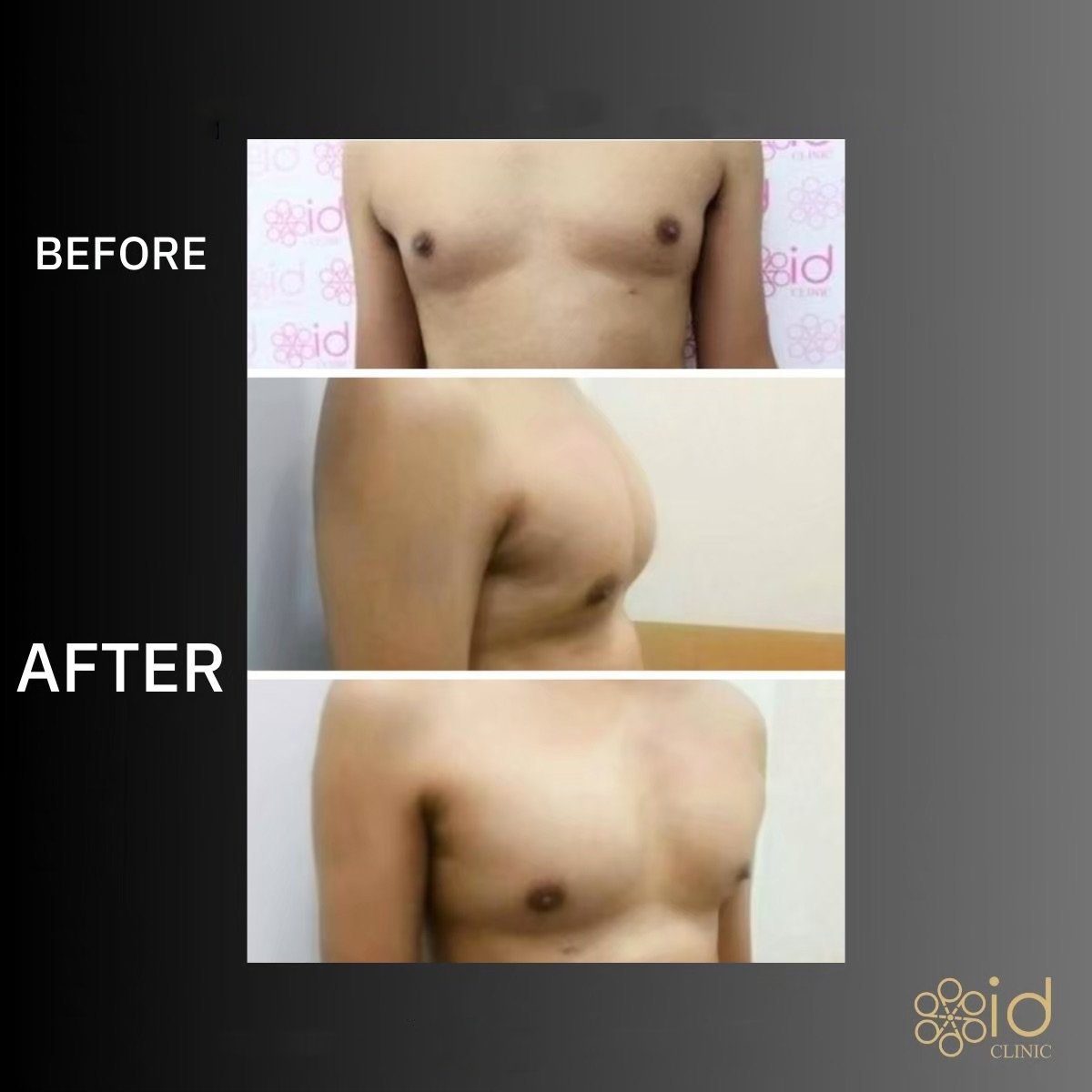 قبل وبعد زراعة عضلات الصدر في ID Clinic Bangkok – تحسين شكل الصدر للرجال