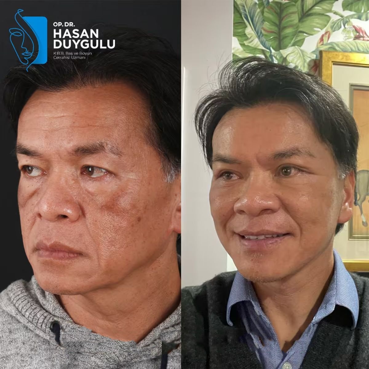 Efekty przed i po deep plane facelift w klinice Dr. Hasan Duygulu w Turcji