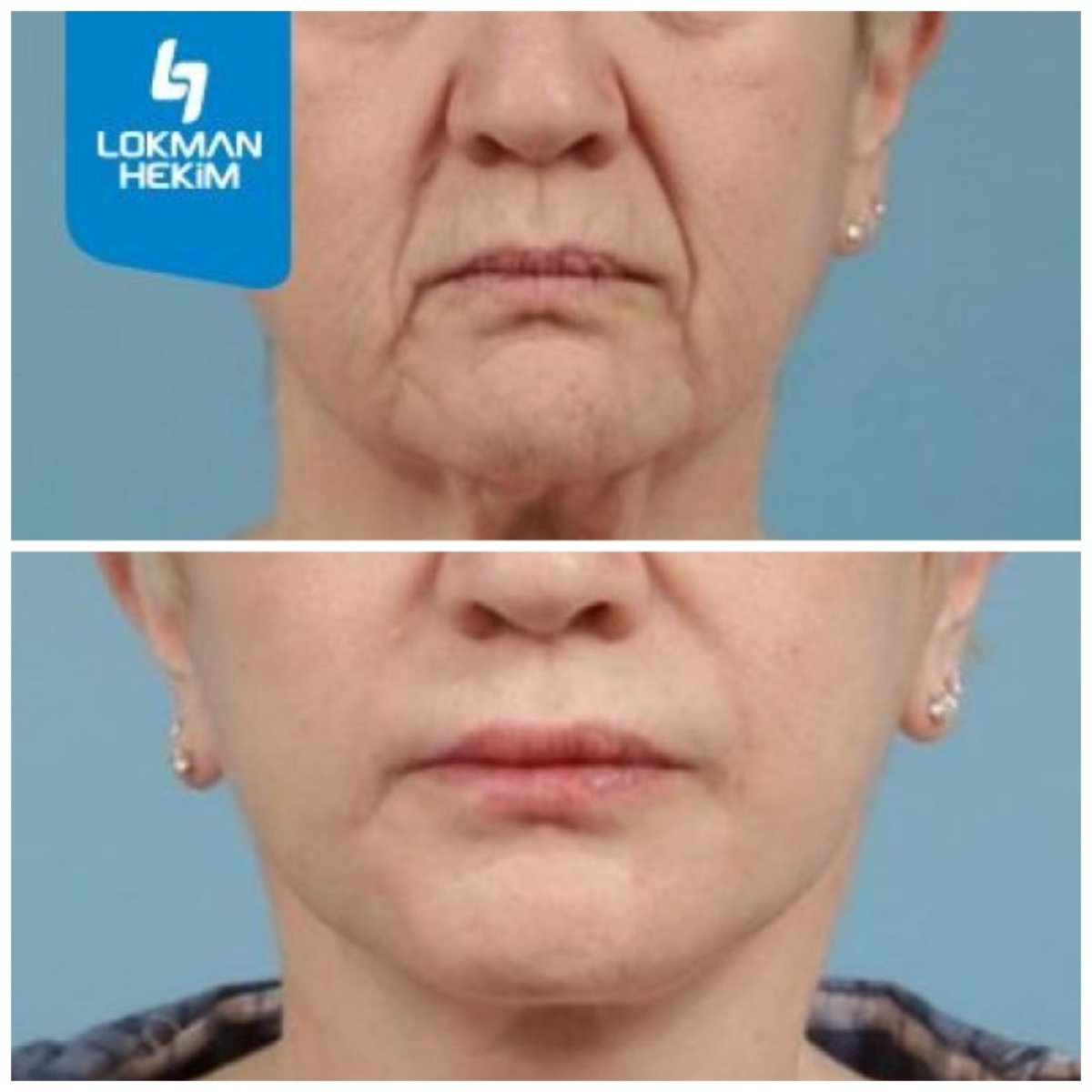 before and after photo