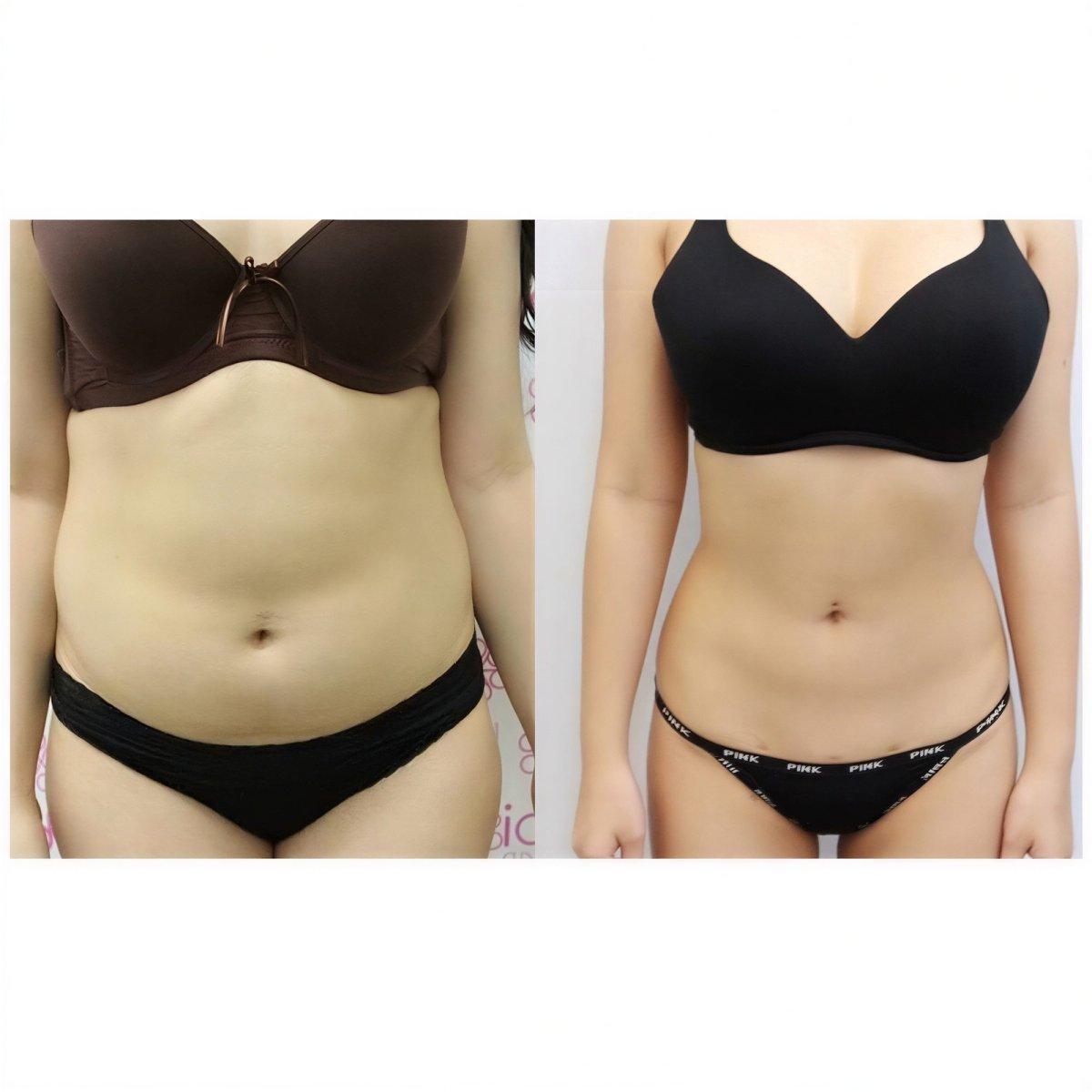 Resultados de liposucción abdominal antes y después en Somchai Clinic, cintura mejorada