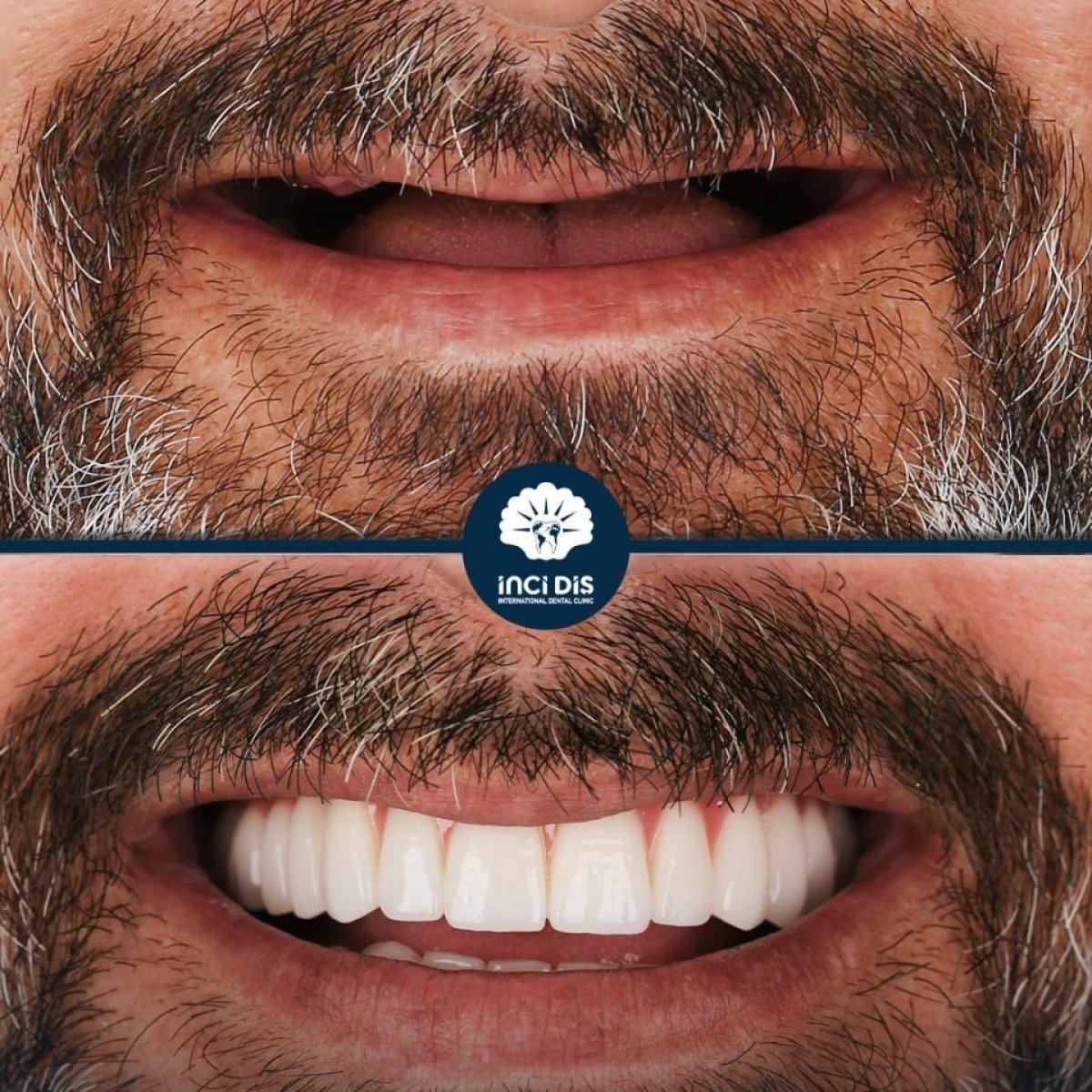 Результат до и после имплантации All-on-4 в Inci Dis International Dental Clinic
