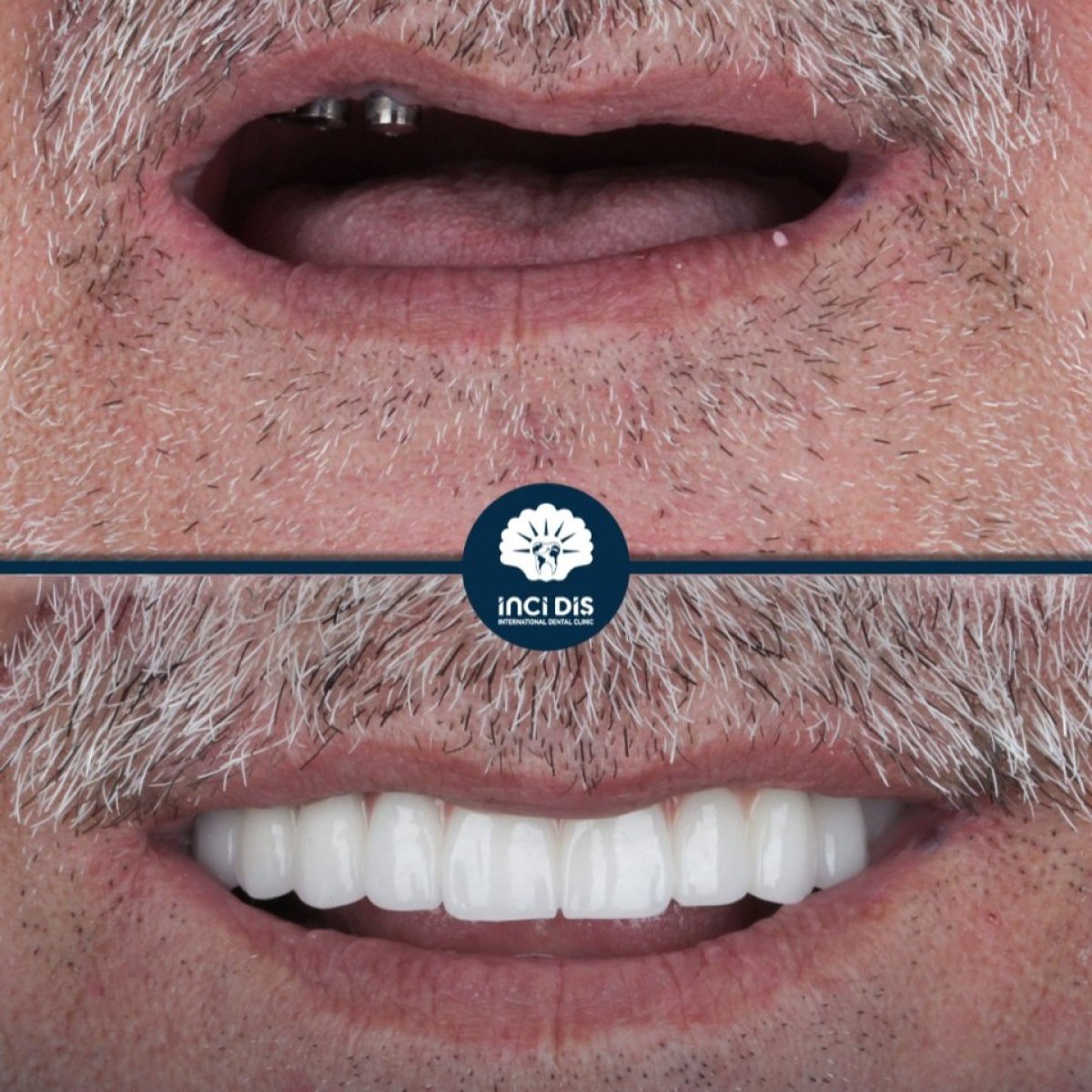 Resultado antes y después de implantes All-on-4 en Inci Dis International Dental Clinic