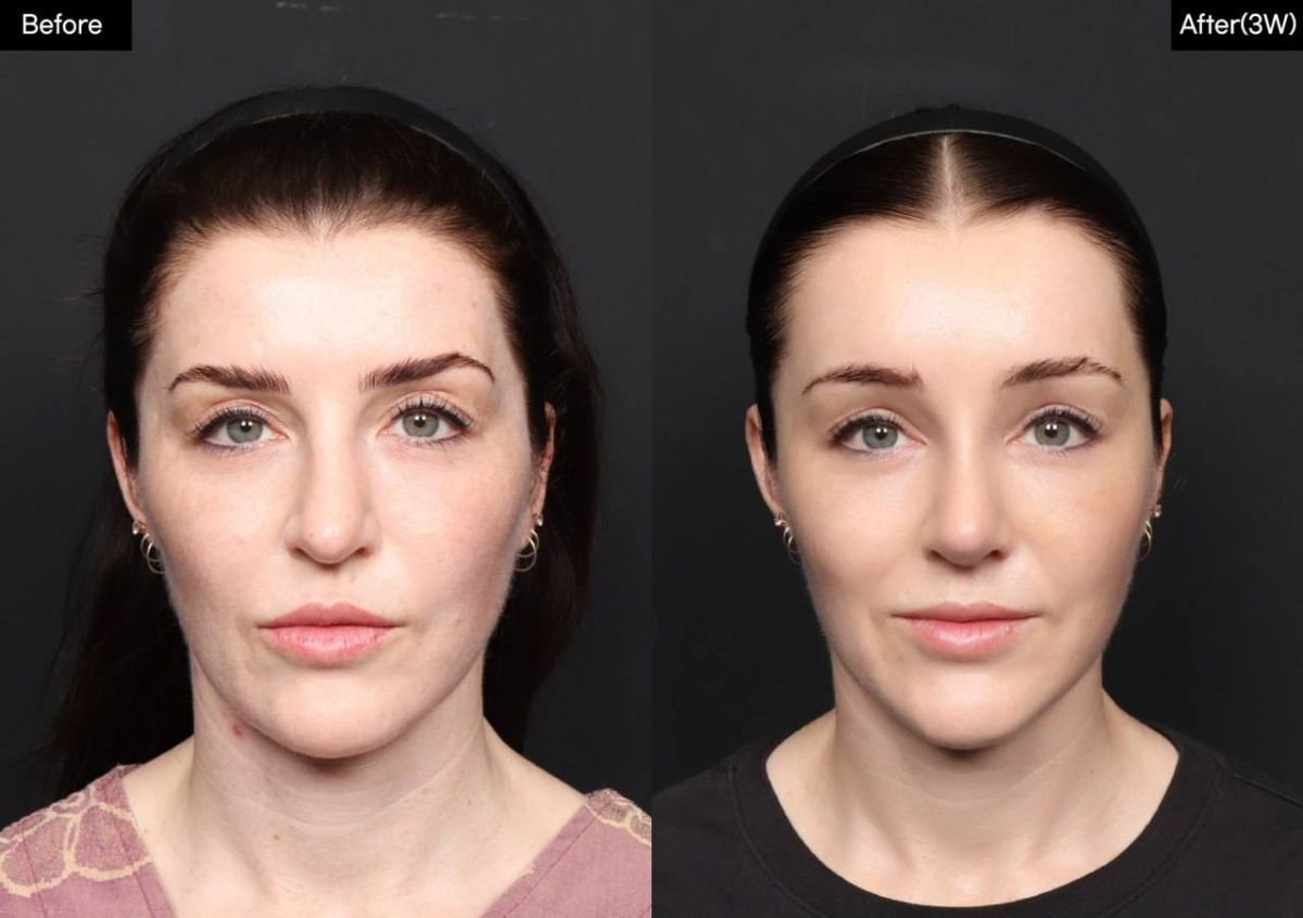 Efekty przed i po liftingu brwi w VG Plastic Surgery, widoczne uniesienie brwi