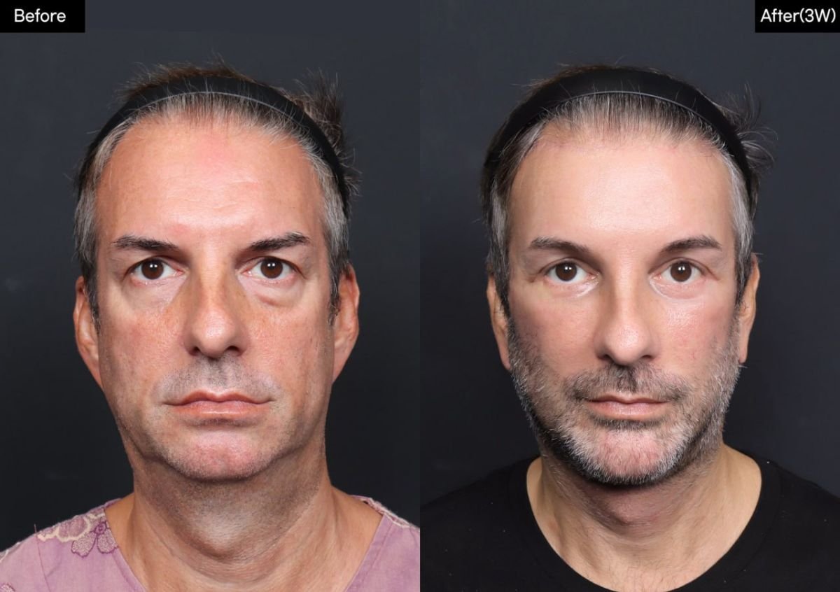 نتائج شد الوجه العميق قبل وبعد في VG Plastic Surgery، تجديد شباب الوجه بوضوح