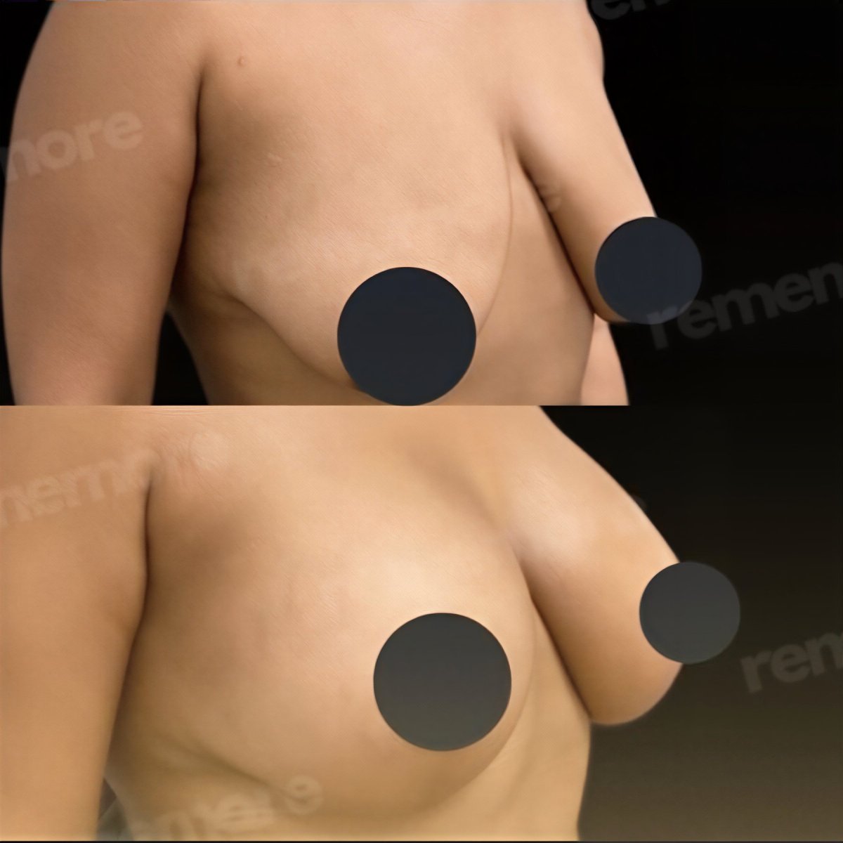 Before and after mammoplasty results at Memorial Bahçelievler Hospital, breast enhancement