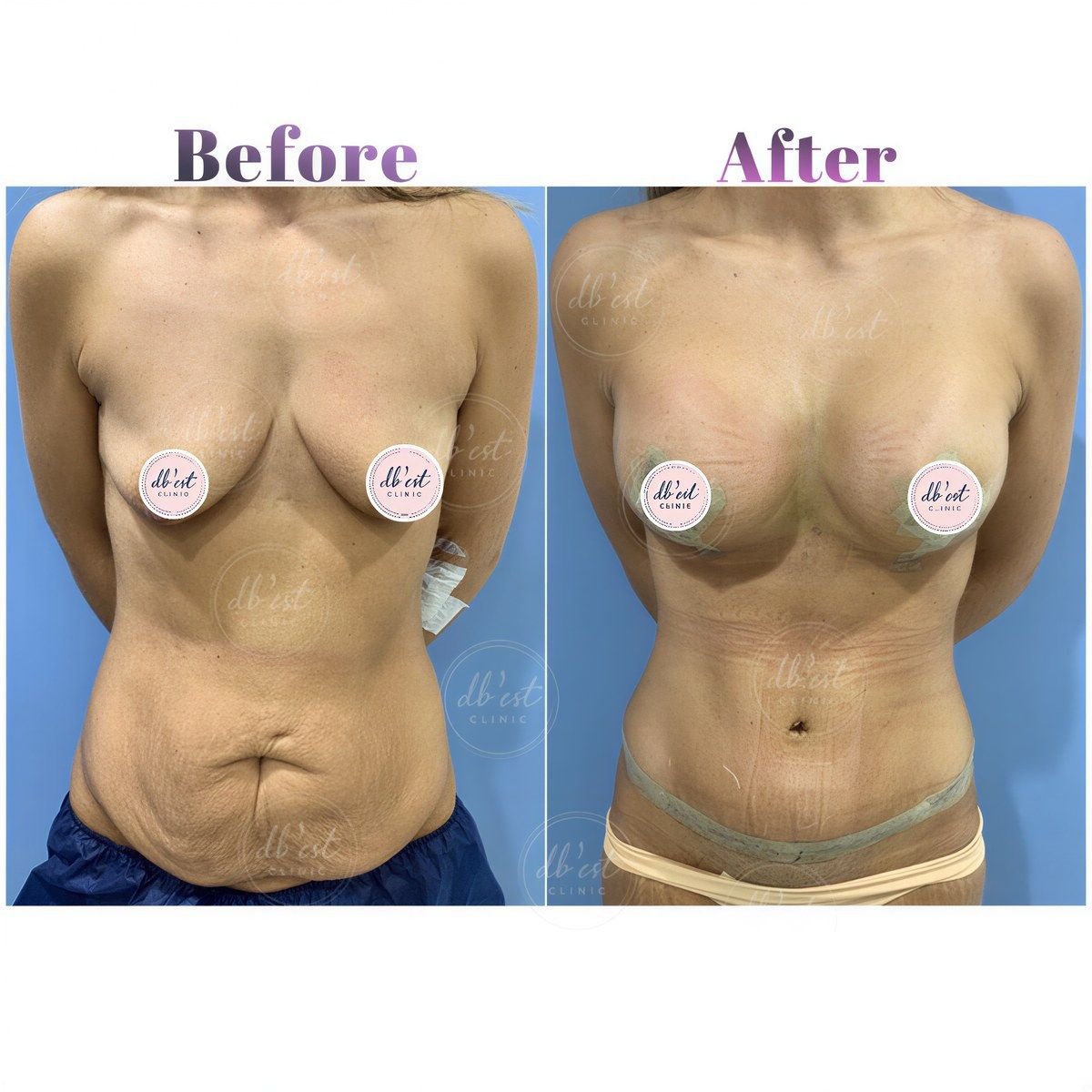 Resultados antes y después de aumento de senos y abdominoplastia en Db'est Clinic