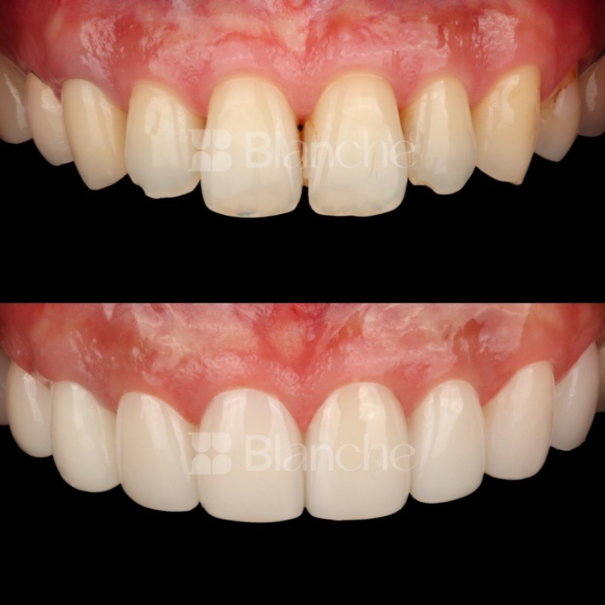 Resultado antes y después de carillas sin tallado en clínica Blanche – sonrisa mejorada