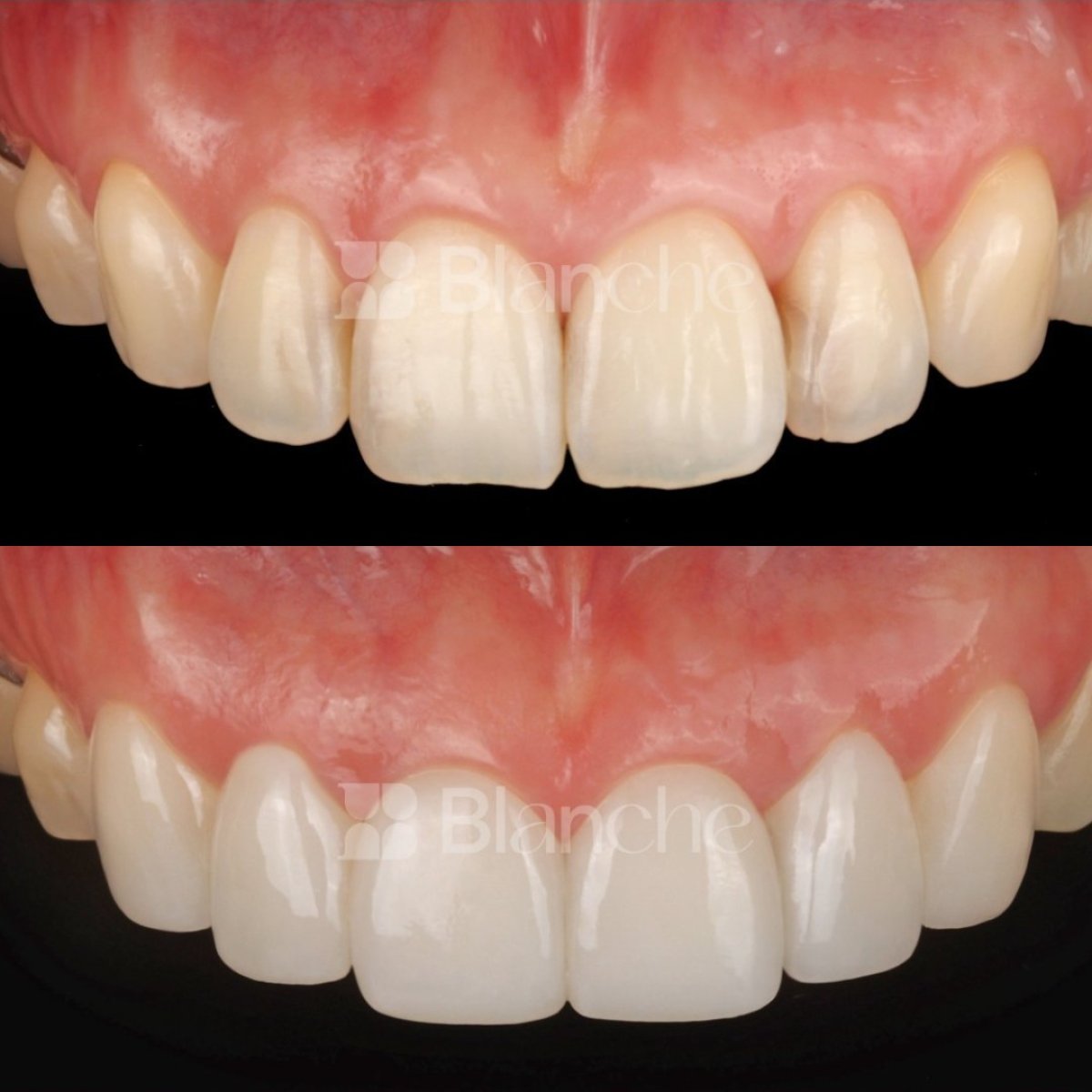 Antes y después de carillas sin tallado en clínica Blanche – sonrisa natural mejorada