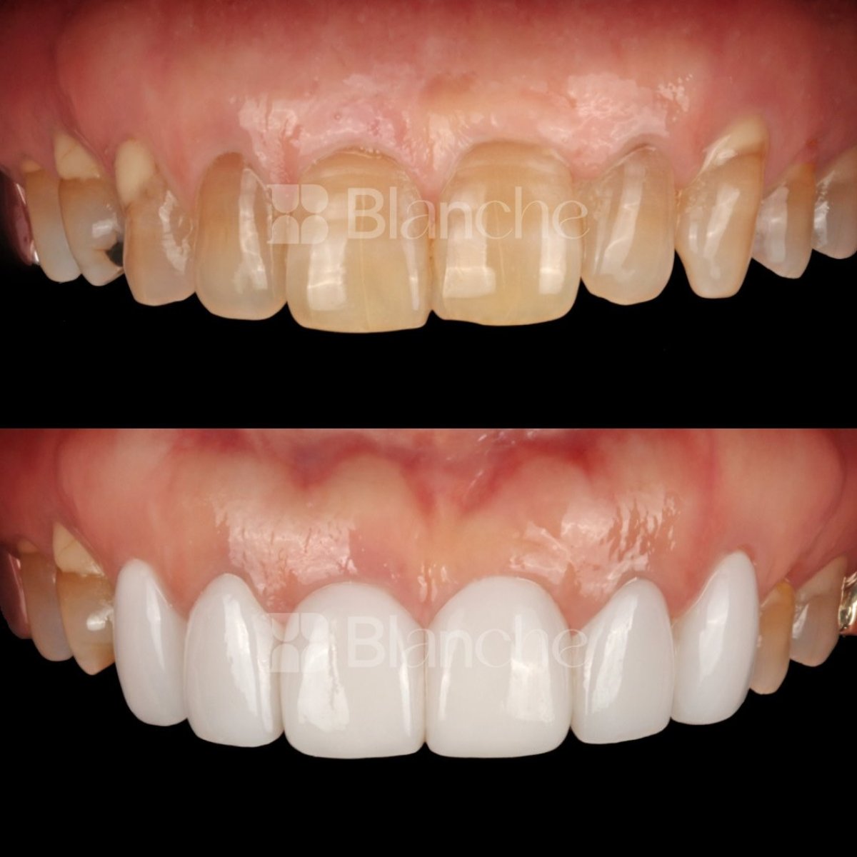 Antes y después de carillas sin tallado en clínica Blanche – transformación natural de la sonrisa