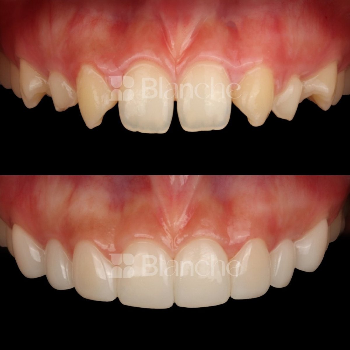 Before and after no prep veneers at Blanche clinic – smile makeover with natural results