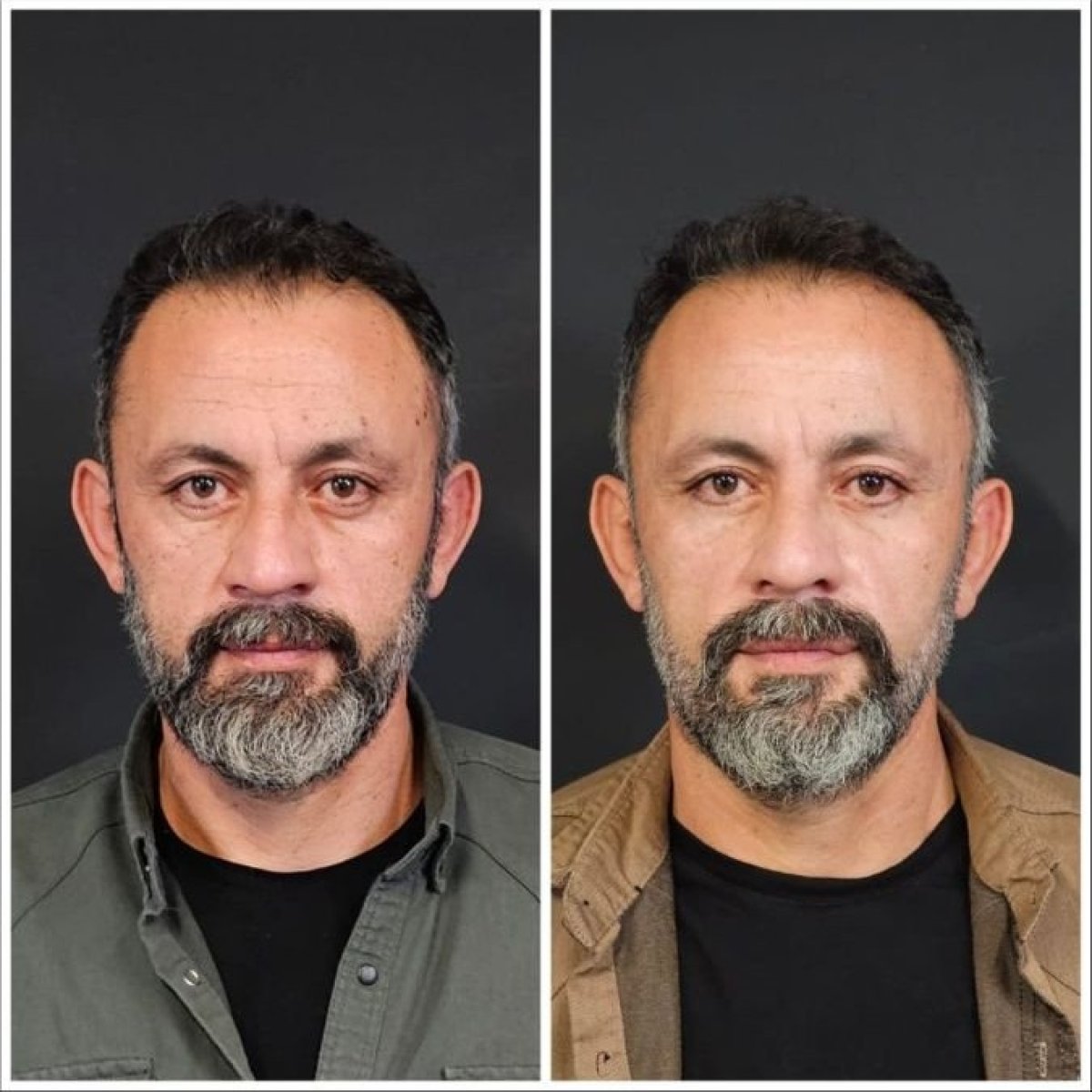 Resultados de lifting facial antes y después en VM Medical Park Pendik Hospital, rejuvenecimiento