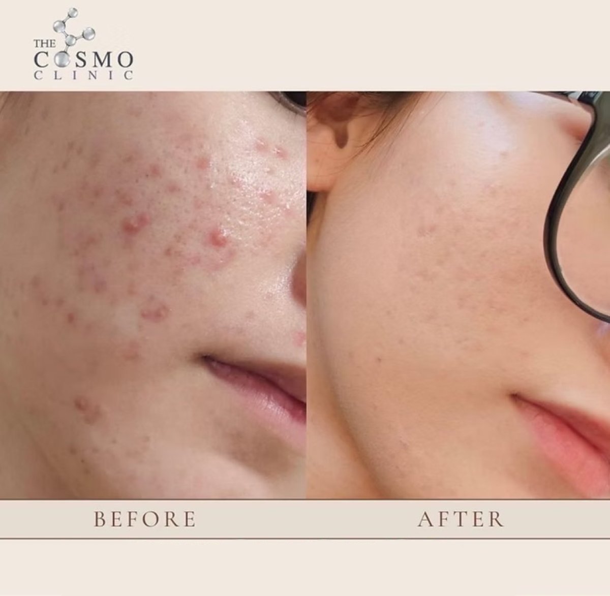 Before and after acne scar treatment at The Cosmo Clinic – visible skin texture improvement result