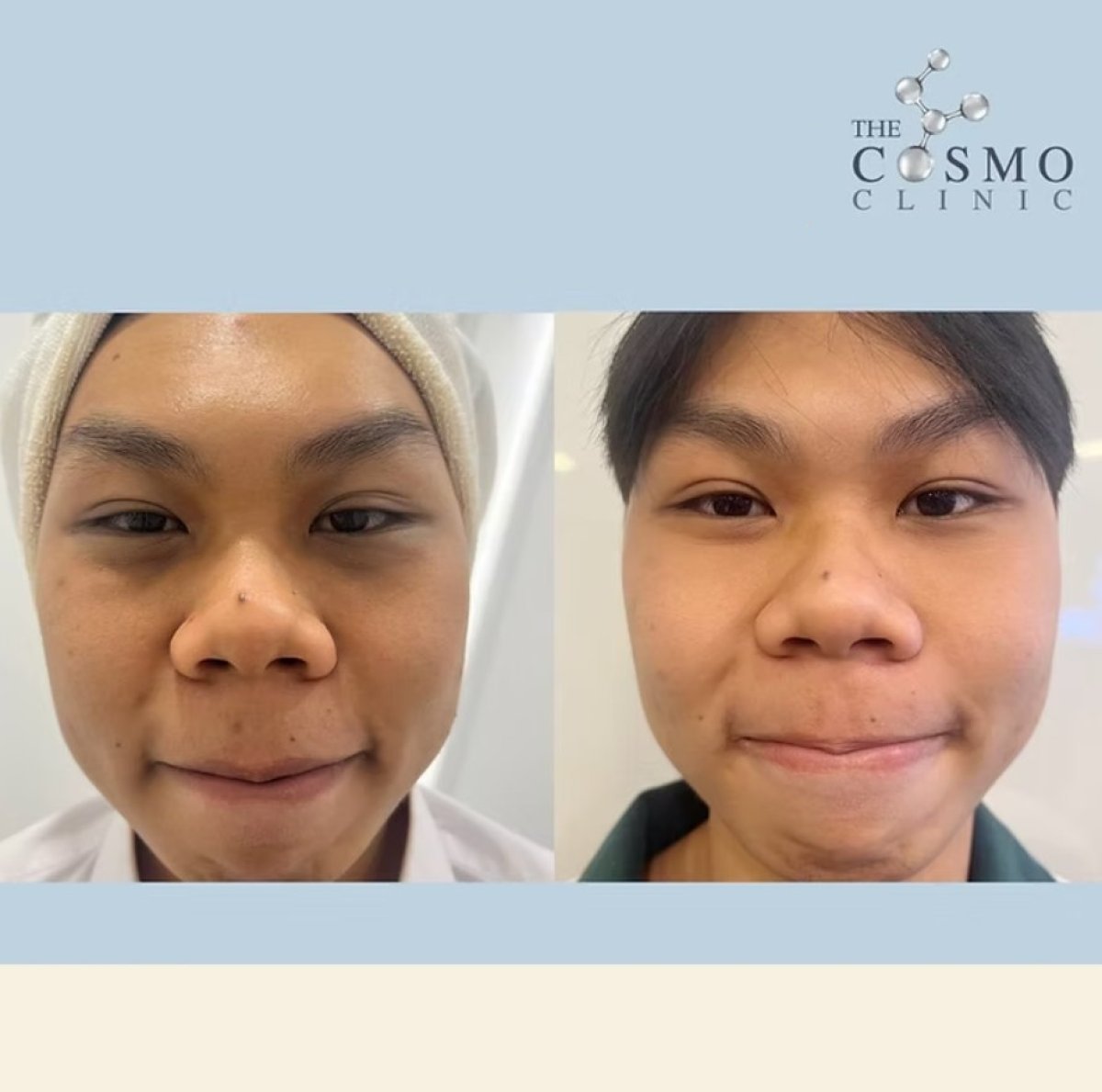 Resultados antes y después de rellenos en The Cosmo Clinic, mejora del contorno facial
