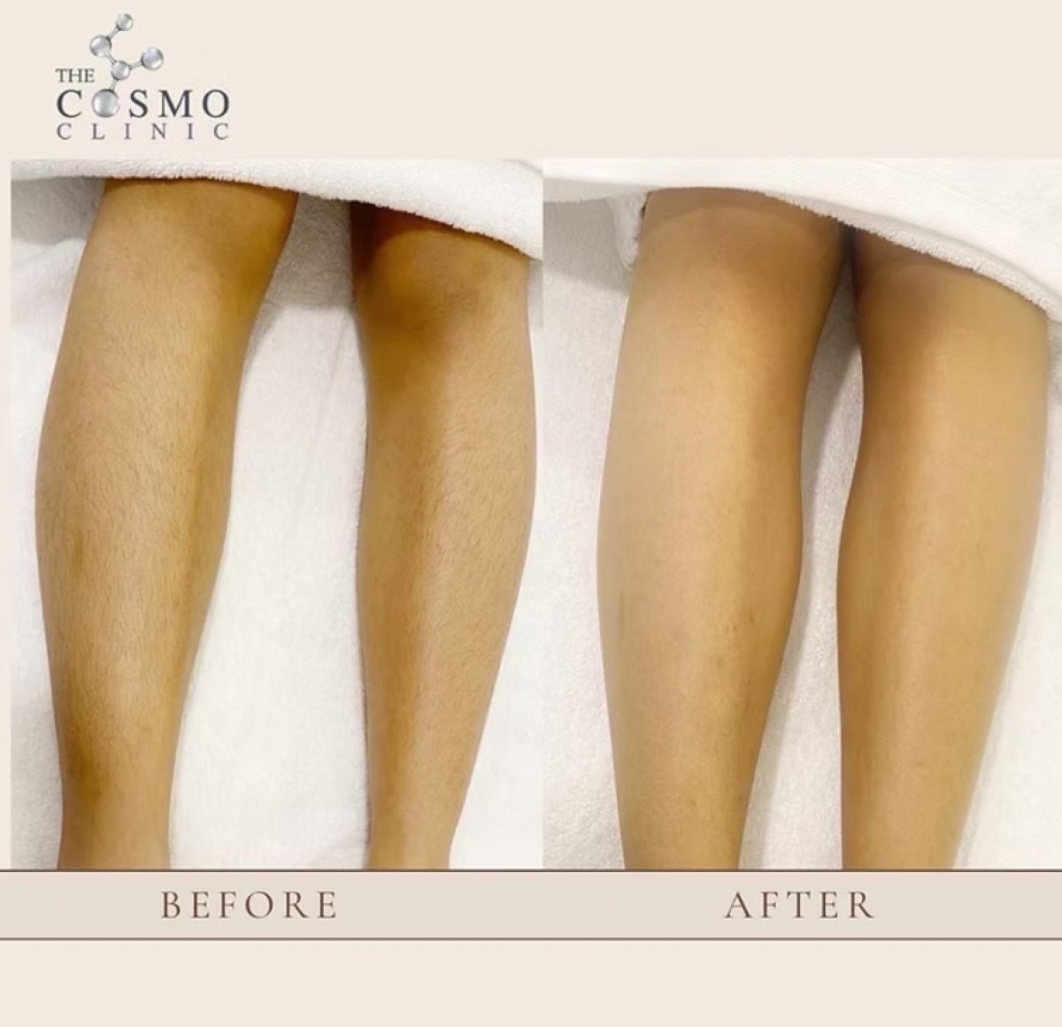 Resultados de depilación láser en piernas antes y después en The Cosmo Clinic, piel suave