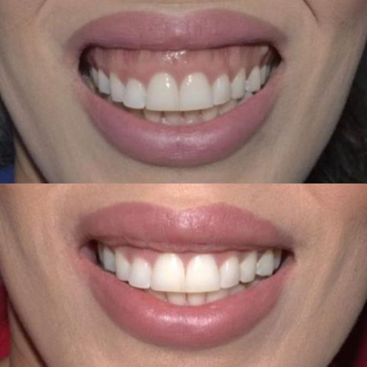 نتائج قبل وبعد جينجيفيكتومي في SoftDentalCare Clinic، تحسين خط اللثة والابتسامة