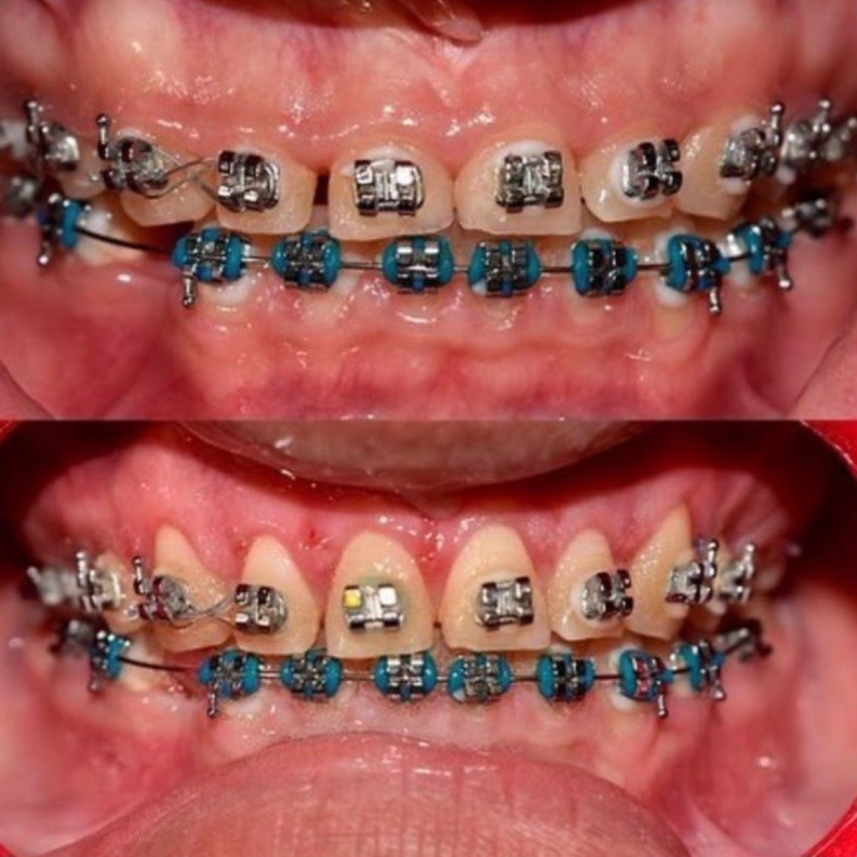 نتائج قص اللثة قبل وبعد مع التقويم في SoftDentalCare Clinic، تحسين خط اللثة