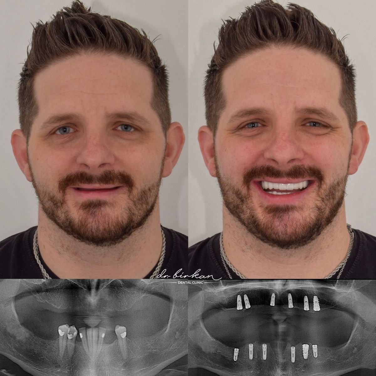 Antes y después de prótesis dental en DR. BİRKAN DURAS CLINIC, sonrisa e implantes mejorados
