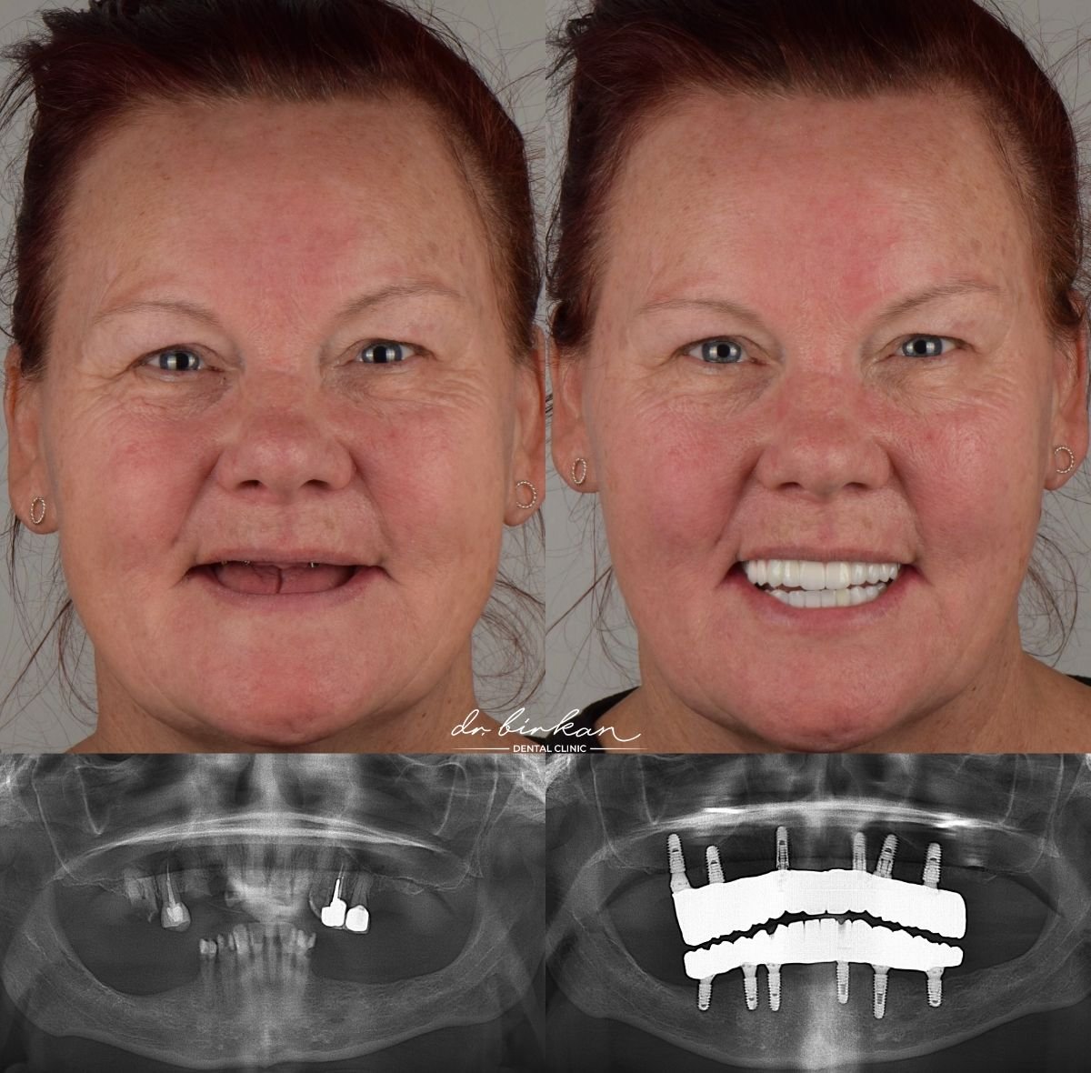 Resultados antes y después de dentadura en DR. BİRKAN DURAS CLINIC – restauración total con implantes