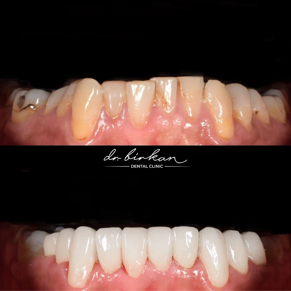 Resultados de dentadura antes y después en DR. BİRKAN DURAS CLINIC – sonrisa mejorada