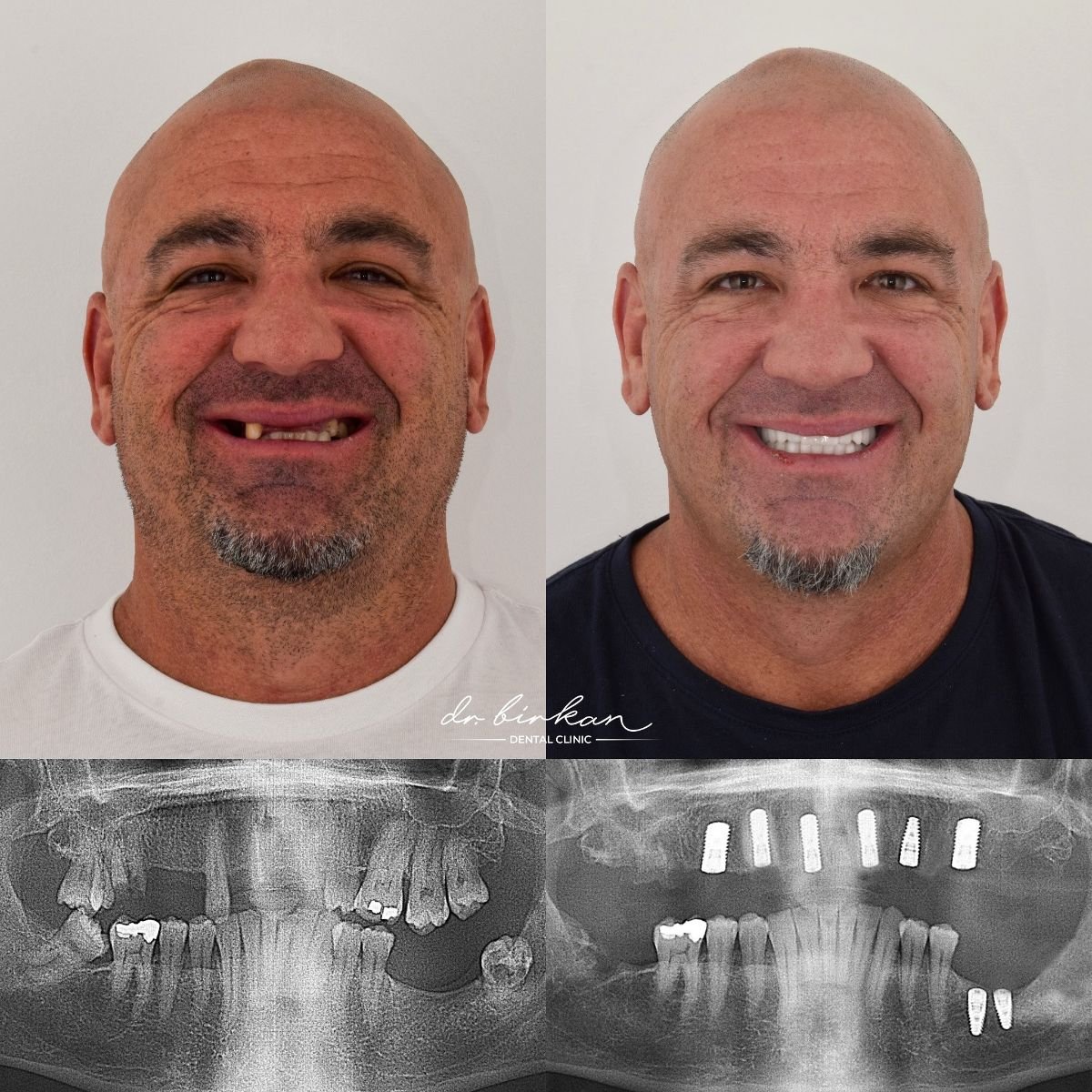 Resultados antes y después de dentadura en DR. BİRKAN DURAS CLINIC – restauración total de sonrisa