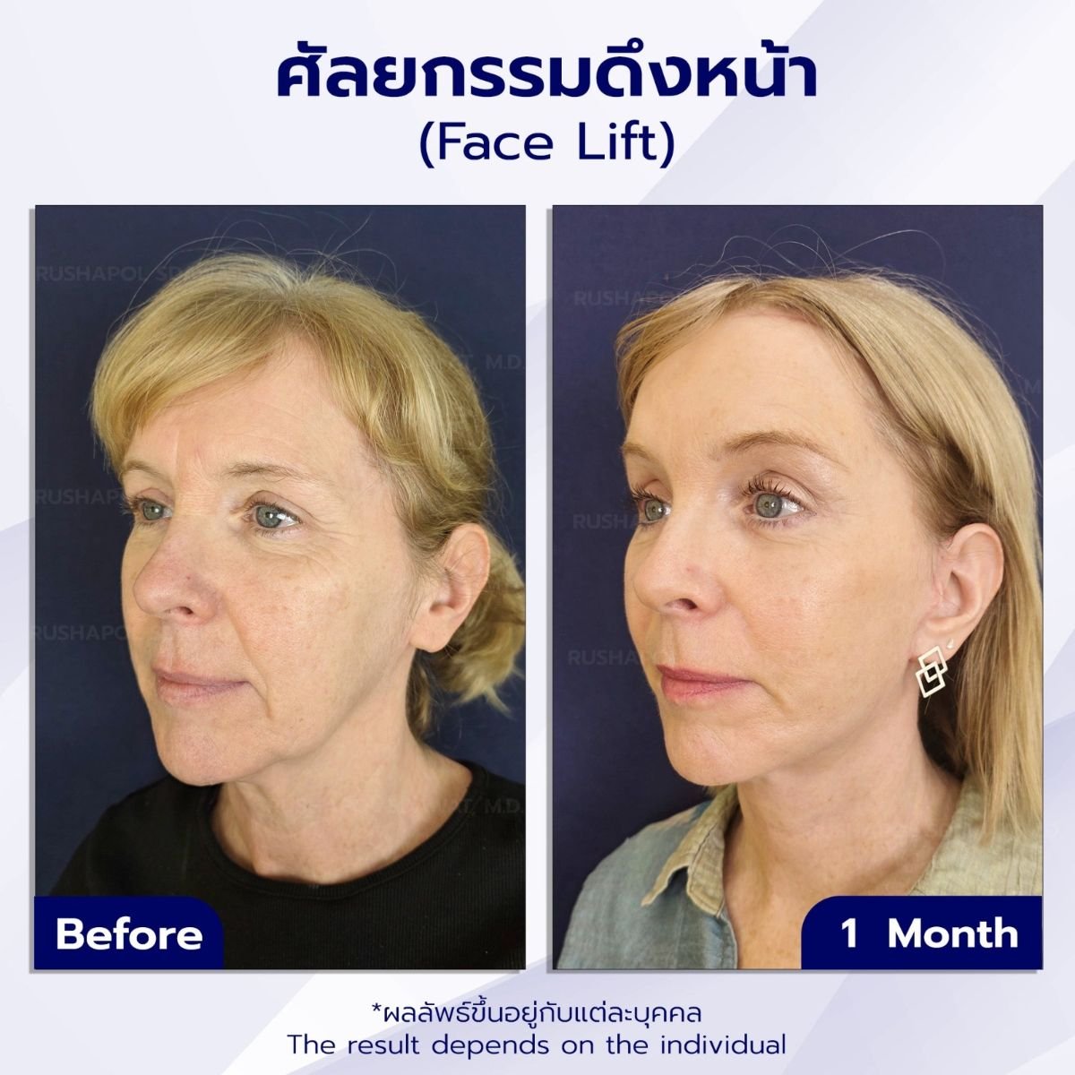 Resultados antes y después de deep plane facelift en Intrarat Hospital, rejuvenecimiento facial