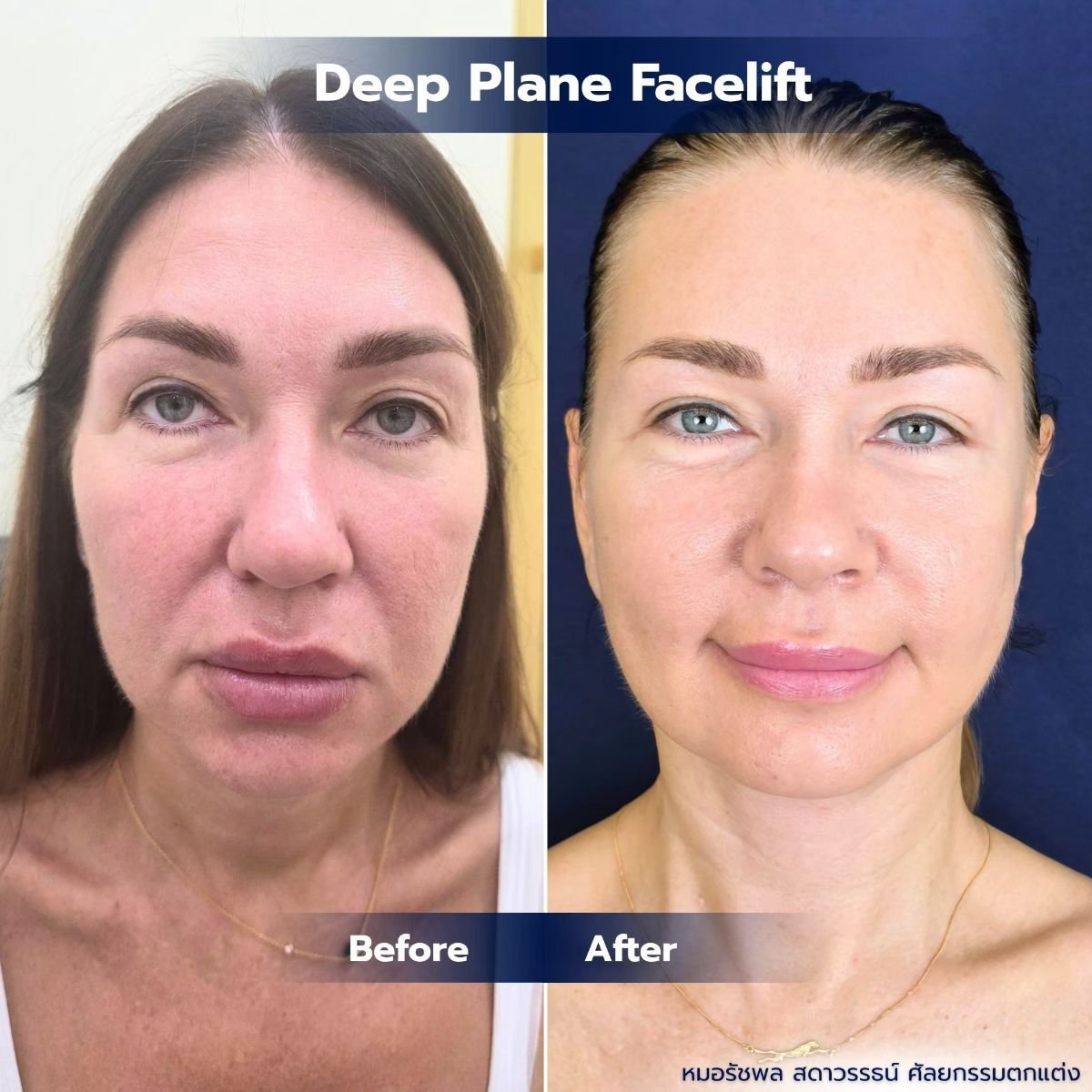 Resultados antes y después de deep plane facelift en Intrarat Hospital, rejuvenecimiento facial