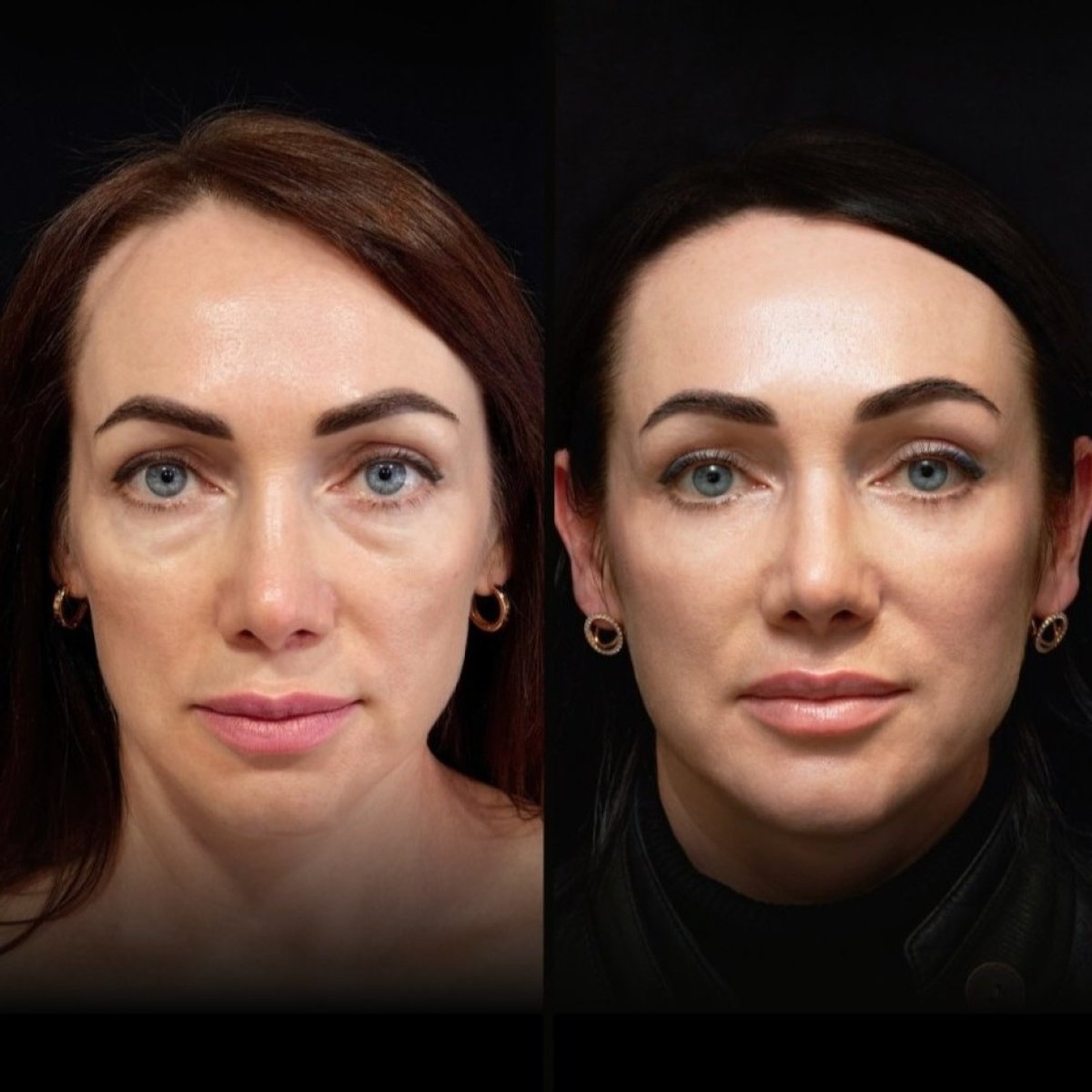 Before and after lower eyelid blepharoplasty results at Vidnova Clinic, reduced under-eye bags