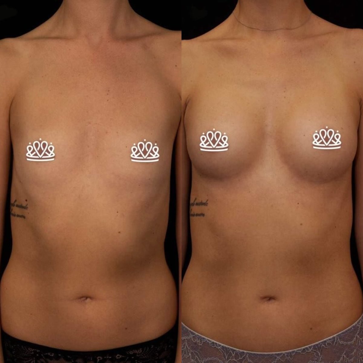 Resultados de mamoplastia antes y después en Vidnova Clinic – aumento visible de senos
