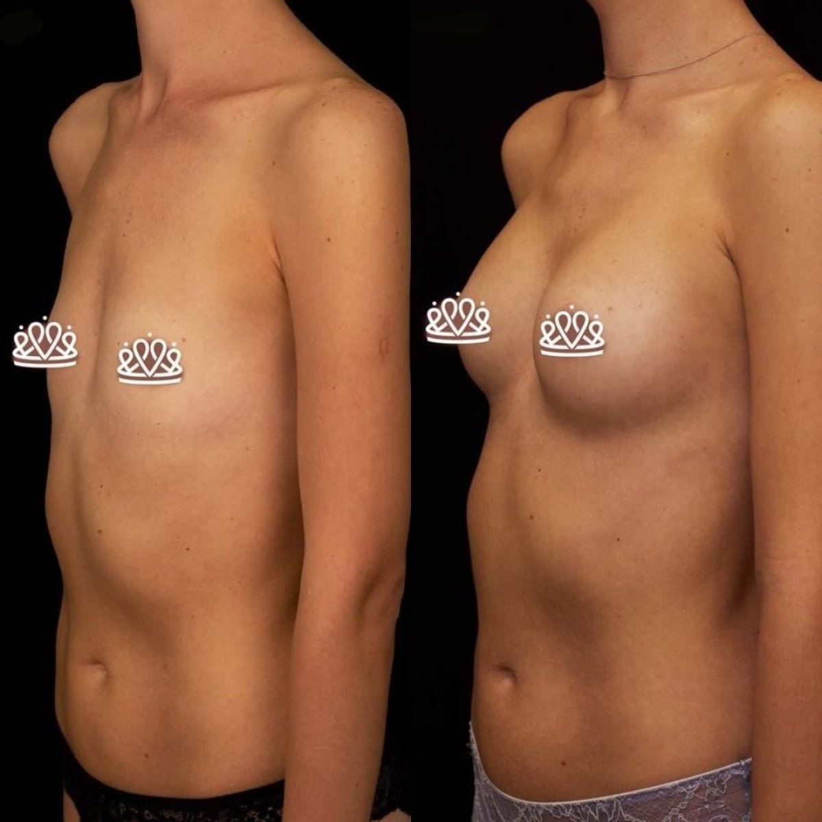 Resultados de mamoplastia antes y después en Vidnova Clinic – aumento visible de senos