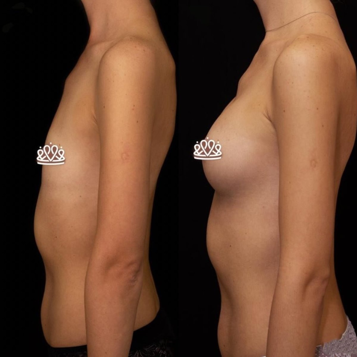 Resultados de mamoplastia antes y después en Vidnova Clinic – mayor forma y volumen mamario