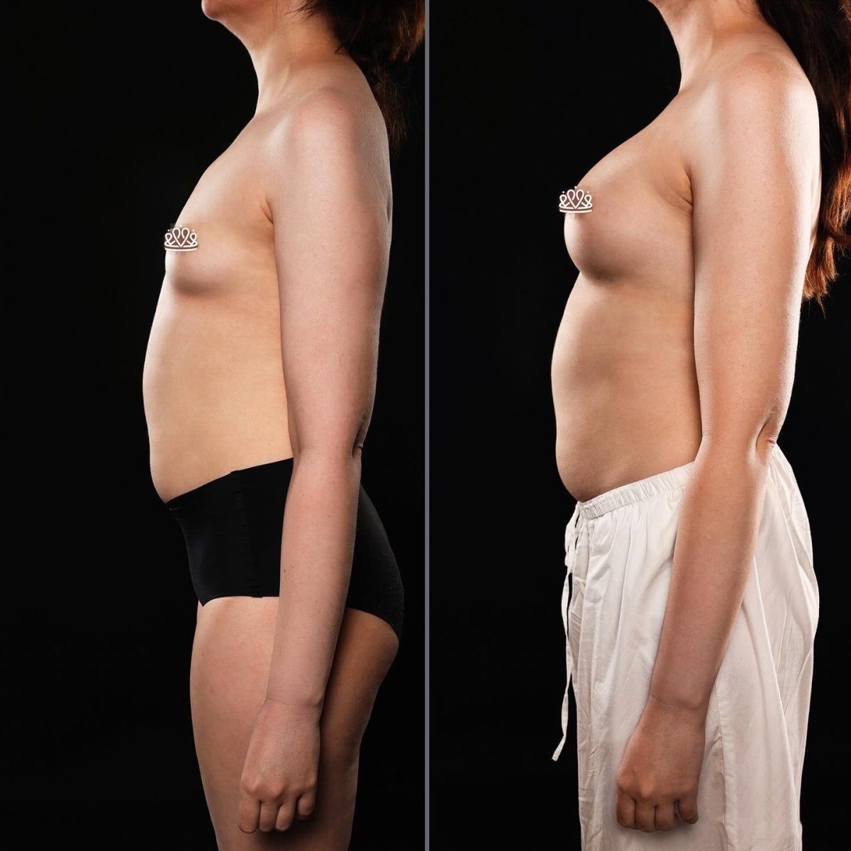 Resultados de mamoplastia antes y después en Vidnova Clinic – aumento visible de senos