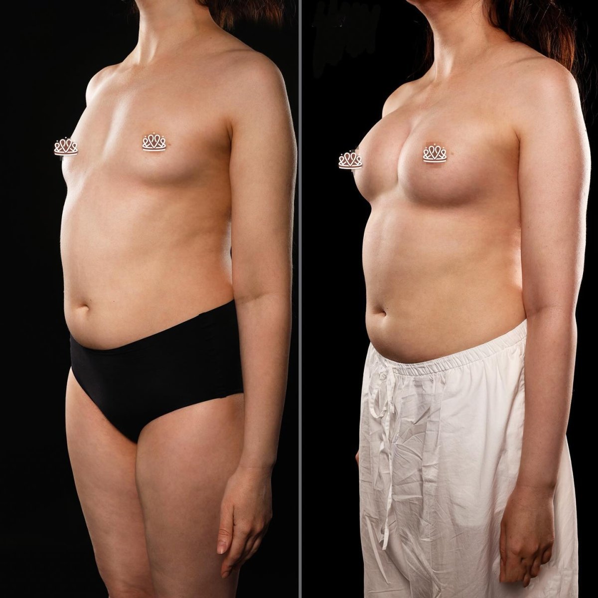 Resultados de mamoplastia antes y después en Vidnova Clinic – aumento visible de senos