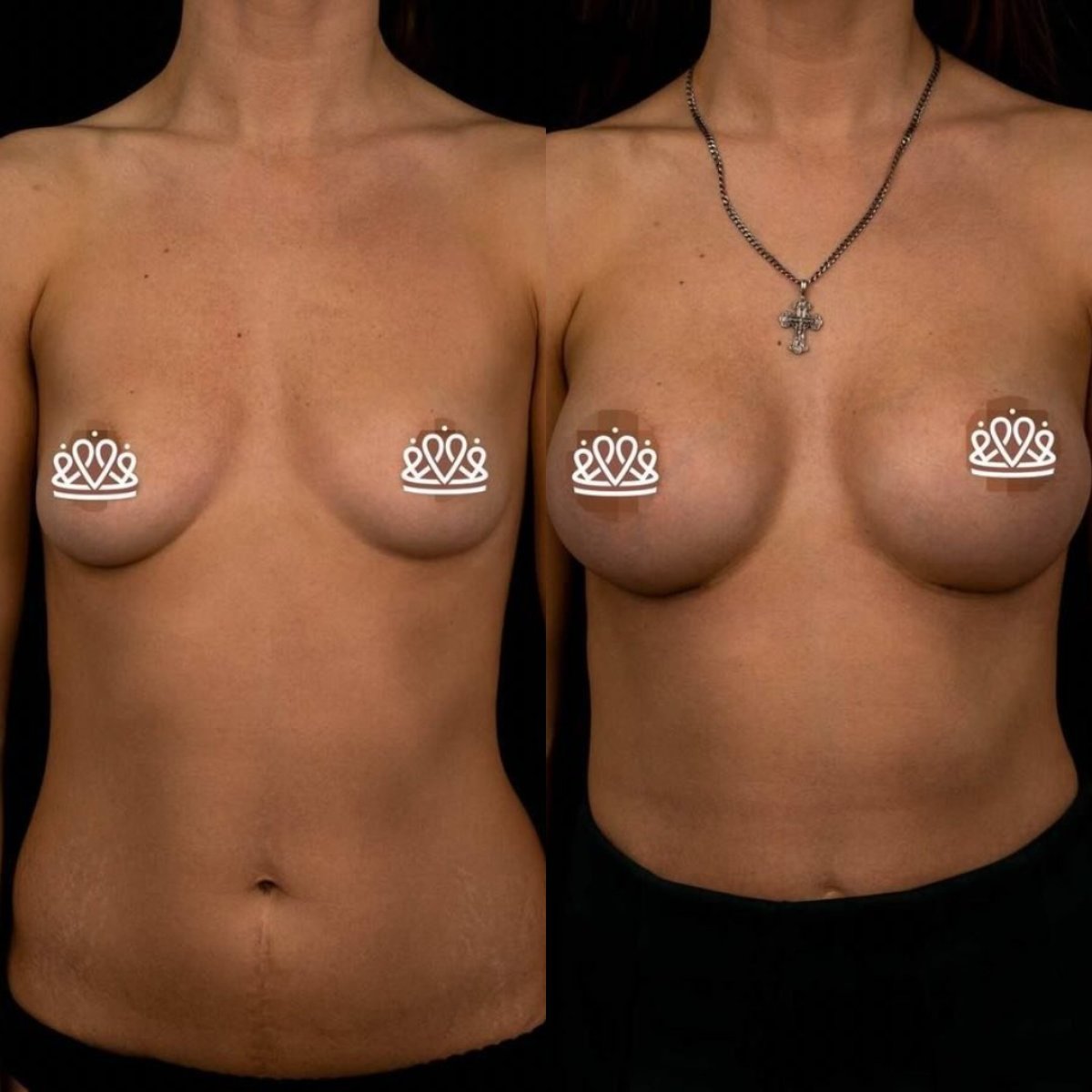 Resultados de mamoplastia antes y después en Vidnova Clinic, aumento visible de senos
