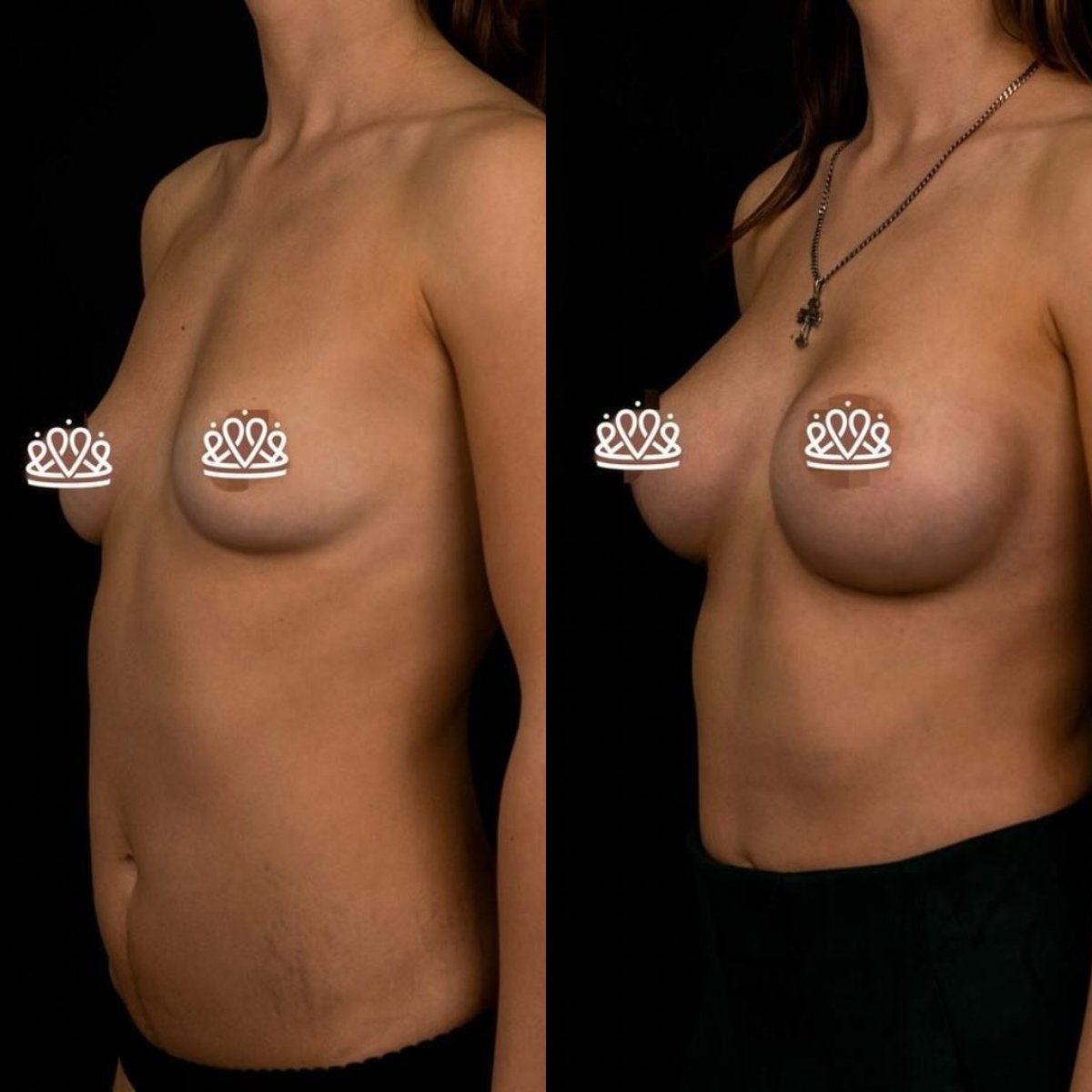 Resultados de mamoplastia antes y después en Vidnova Clinic – aumento visible de senos