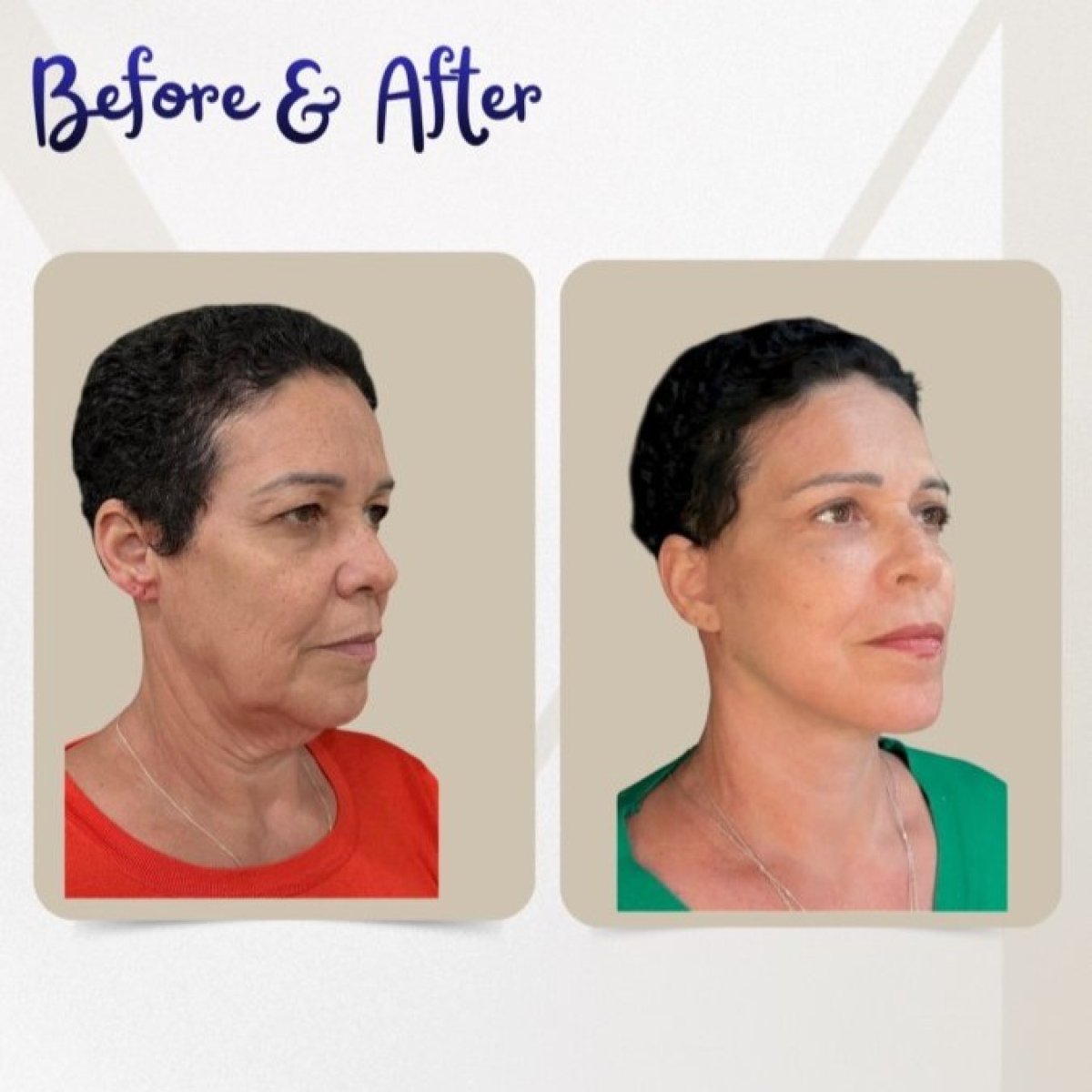 نتائج رأب الجفن قبل وبعد في عيادة Dr. Michel Salameh - Plastic And Aesthetic Surgery