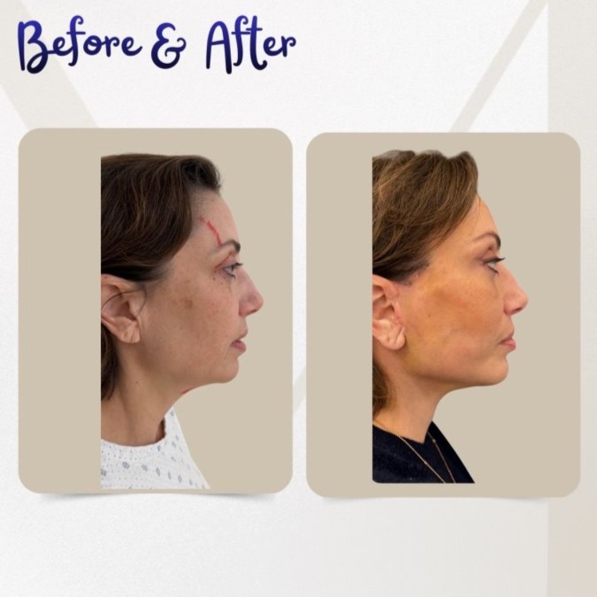 نتائج رأب الجفن قبل وبعد في عيادة Dr. Michel Salameh - Plastic And Aesthetic Surgery