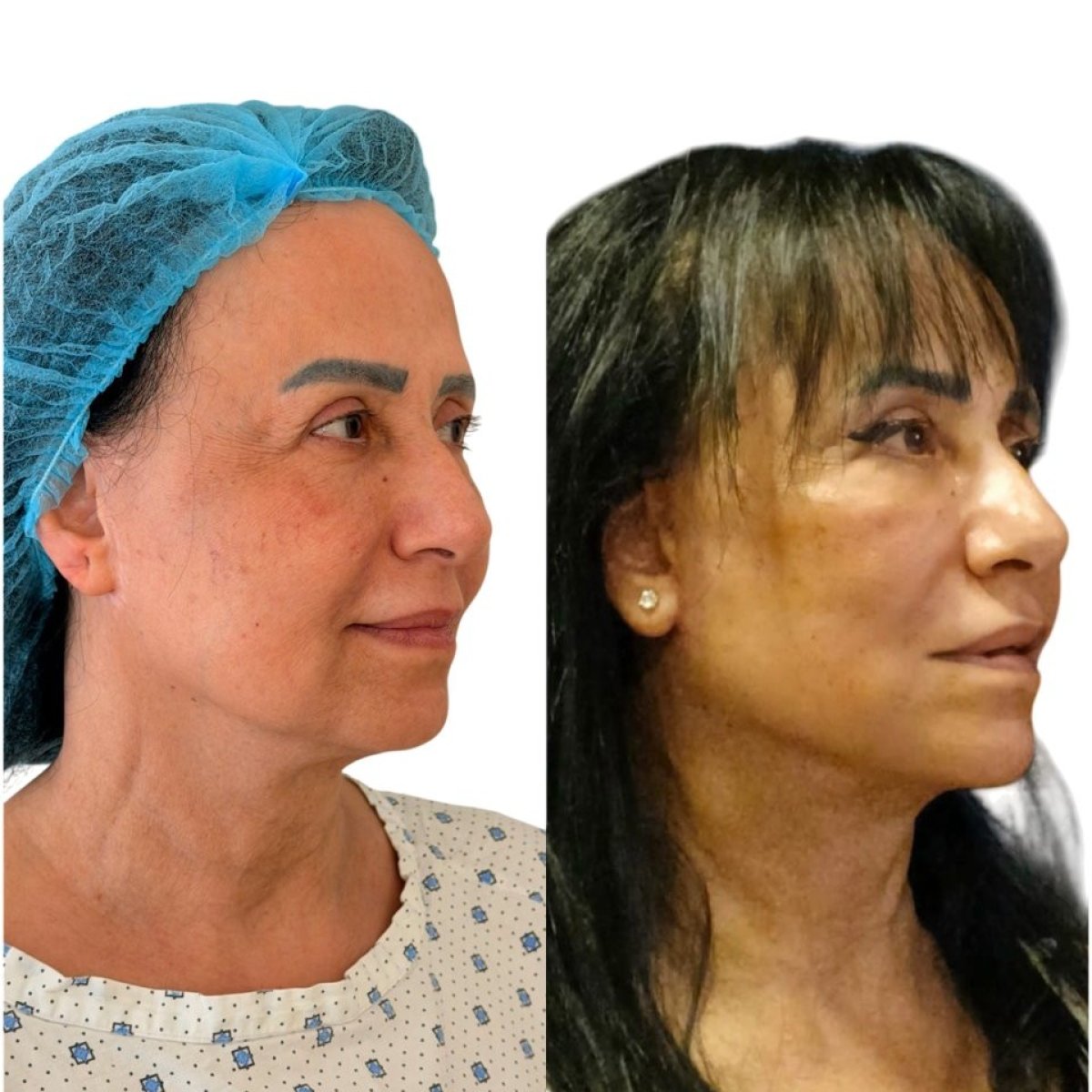 نتائج رأب الجفن قبل وبعد في عيادة Dr. Michel Salameh - Plastic And Aesthetic Surgery
