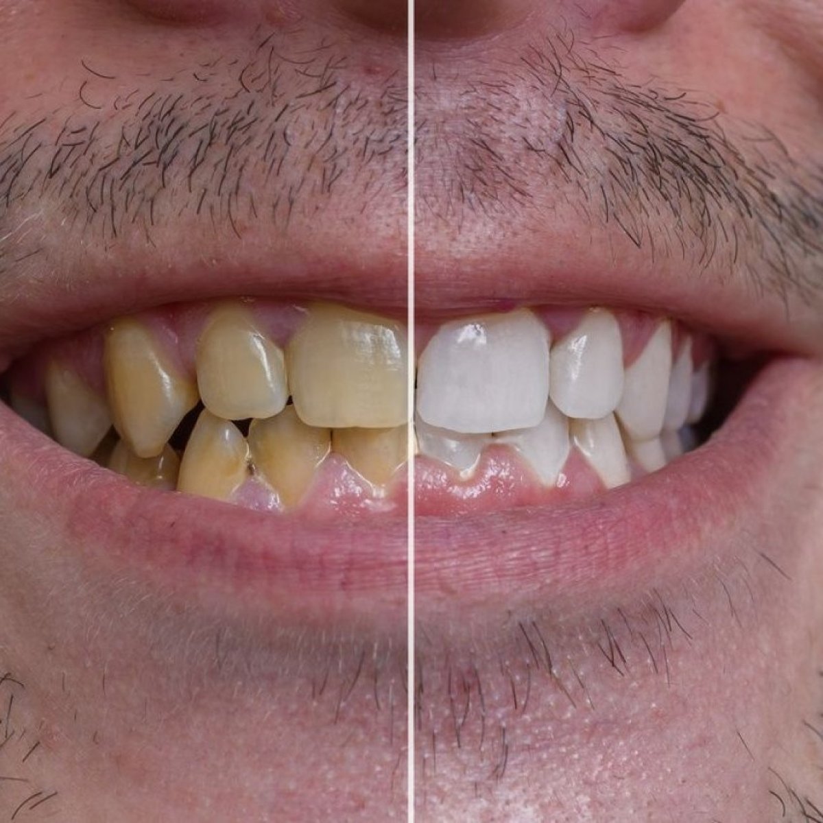 Resultados de blanqueamiento dental antes y después en Xiamen Humanity Hospital, sonrisa brillante