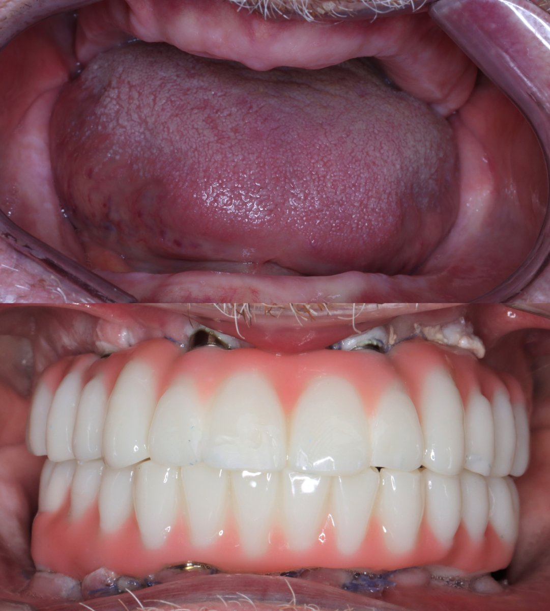 Resultado antes y después de implantes All-on-4 en VBright Dental – restauración total de sonrisa
