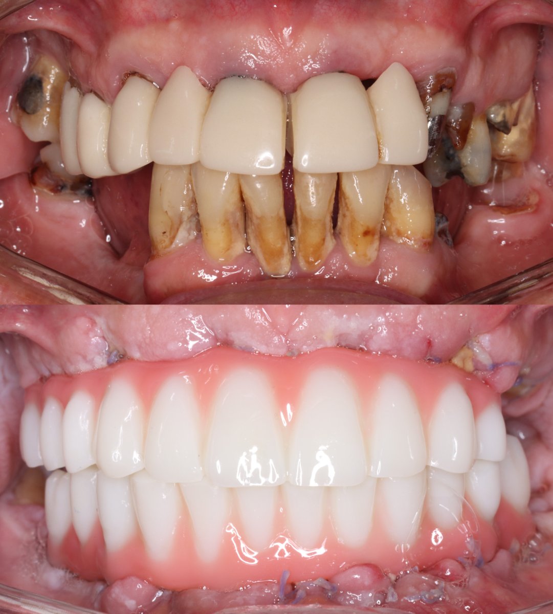 Before and after All-on-4 dental implants result at VBright Dental, full smile restoration