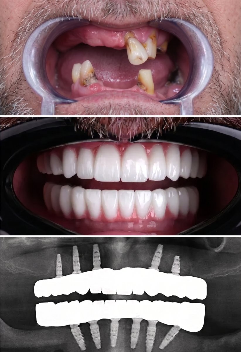 Before and after All-on-4 dental implants result at VBright Dental – full smile restoration