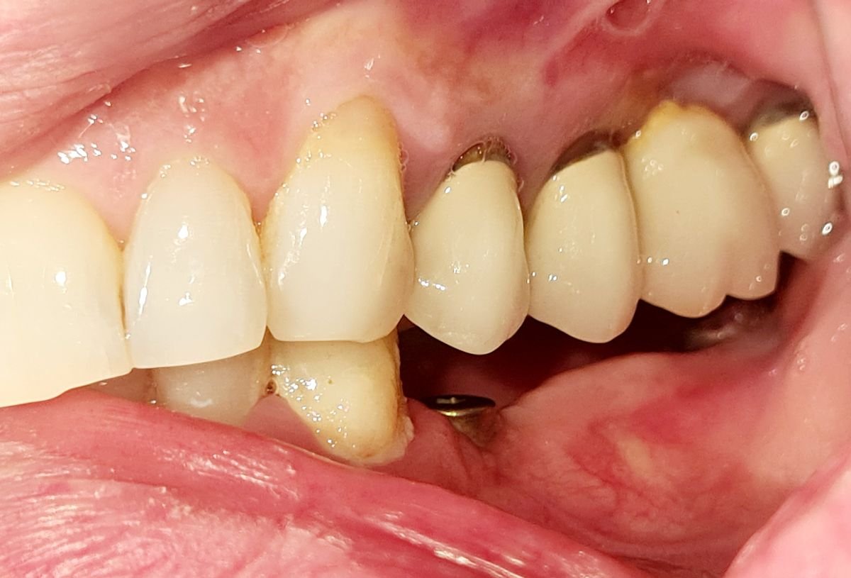 Dental implant result at SoftDentalCare Clinic, restored tooth and improved bite alignment