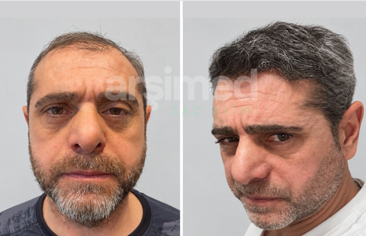 Before and after hair transplant results at Hisar Hospital Intercontinental, restored hairline