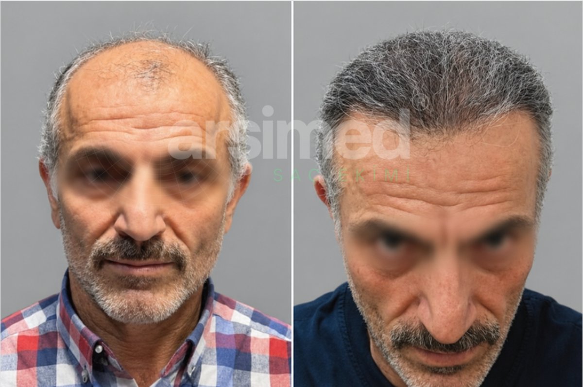 Résultats avant et après greffe de cheveux à Hisar Hospital Intercontinental, ligne restaurée