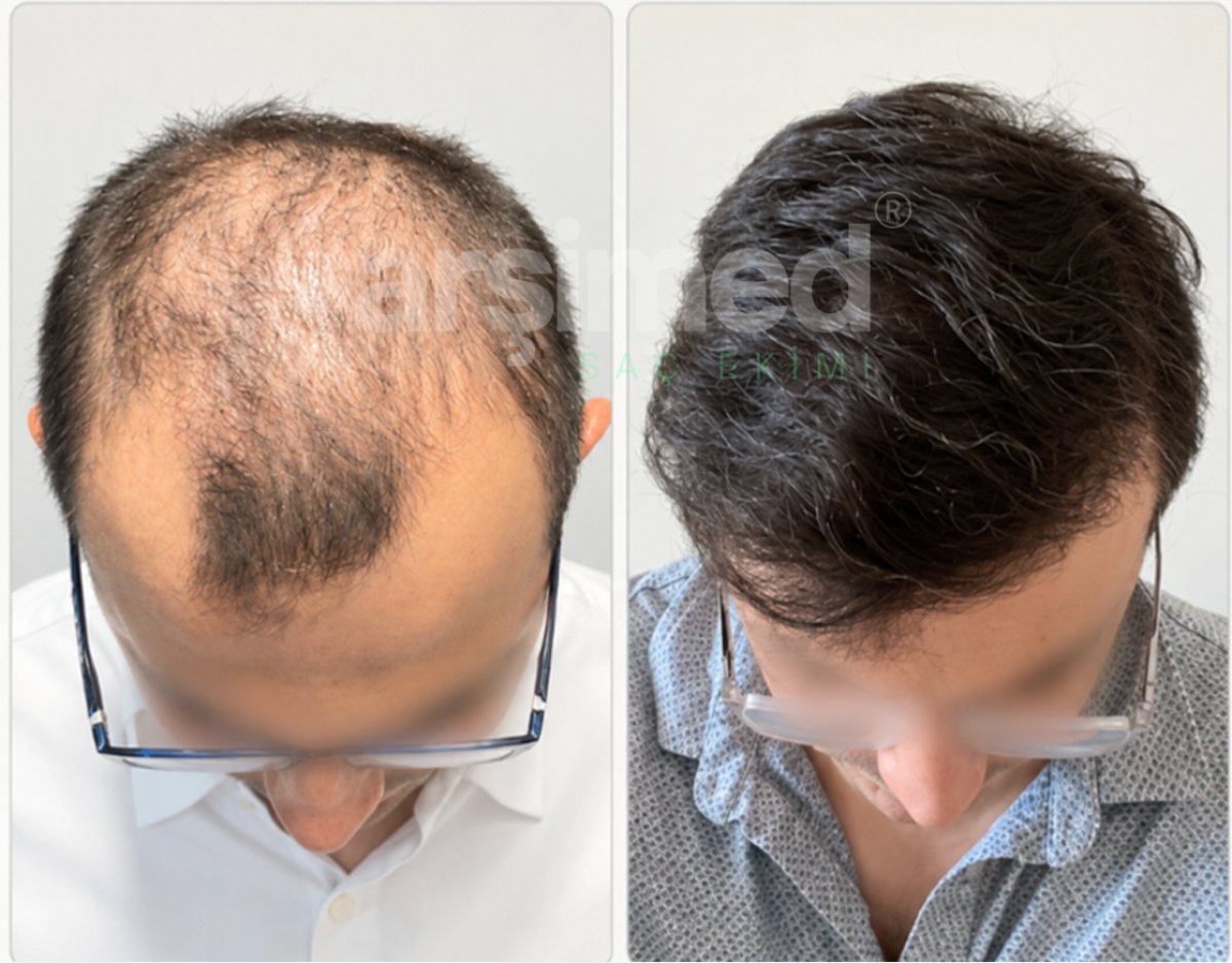 Before and after hair transplant results at Hisar Hospital Intercontinental, restored hair density